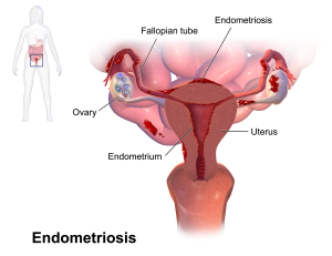 Endometriosis Vivekanantha homeopathy clinic & psychological counseling center, Velachery, Chennai, panruti, cuddalore, Pondicherry, villupuram, Dr.senthil kumar best homeopathy specialist & famous psychologist in tamilnadu, india, கருப்பை உட்சுவர் சவ்வு அழற்சி - Endometriosis கருப்பையின் உட்சுவர் சவ்வு, சில சமயங்களில் கருப்பைக்கு வெளியேயும் வளர ஆரம்பிக்கும். இப்பிரச்சனையைத்தான் நாம் கருப்பை உட்சுவர் சவ்வு அழற்சி (Endometriosis) என்கிறோம். கருத்தரித்தலை வெகு நாட்களுக்கு செயற்கையாகத் தள்ளிப் போடும் பெண்கள், நீண்ட நாட்களுக்குப் பிறகு கருவுறும் போது இப்பிரச்சனை ஏற்படுகிறது. அதனால் தான் இந்நோயை பணிக்குச் செல்லும் பெண்களின் நோய் (Career Woman’s Diseases) என்று அழைக்கிறார்கள். கருப்பை உட்சுவர் சவ்வு ஒவ்வொரு மாதவிடாய்ச் சுழற்சியின் போதும் சுரக்கும் ஈஸ்ட்ரோஜன் (Oestrogen) மற்றும் புரொஜஸ்டிரான் (Progesterone) ஆகிய ஹார்மோன்களின் அளவைப் பொருத்தே கருப்பைக்குள் வளருகிறது. இந்த ஹார்மோன்கள் அதிகமாக சுரக்கும் போது, இவை நன்கு வளர்ந்துப் பருத்துப் படருகின்றன. ஹார்மோன்களின் சுரப்பு குறையும் பொழுது, இவை கட்டிக் கட்டியாகக் கழன்று மாதவிடாயுடன் சேர்ந்து வெளியேறுகின்றன. ஆனால், கருப்பைக்கு வெளியே வளர்ந்த கருப்பை உட்சுவர்த் திசுக்கள் சரியானபடி வெளியேறப்பாதை இல்லாததால் அவை வயிற்றுக்குள்ளேயே தங்கி, ஒன்றன் மீது ஒன்றாகக் கெட்டியாக ஒட்டி வளருகின்றன. இதைத் தான் நாம் கருப்பை உட்சுவர் சவ்வு அழற்சி என்கிறோம். கருப்பைக்கு வெளியே வளர்ந்த உட்சுவர்த்திசுக்கள் சில சமயங்களில் சினைப்பைகளை பாதித்து, கருப்பை உட்சுவர் சவ்வுக்கட்டிகளாக மாறிவிடக்கூடும். காலப்போக்கில் இவை கறுத்துச் சிவந்த பழுப்பு நிறமாக மாறக்கூடும். இவ்வாறு மாறிய இந்தக் கட்டிகளை சாக்லெட் கட்டிகள் Chocolate Cyst என்று அழைக்கிறோம். இவை பட்டாணியைப் போன்று சிறிதாகவோ அல்லது திராட்சைப் பழத்தைப் போல பெரிதாகவோ இருக்கலாம். கருப்பை உட்சுவர் சவ்வு அழற்சியின் காரணமாக, மாதவிடாயின் போது வலியும், வேதனையும் அதிகமாக ஏற்படும். இதற்குக் காரணம் கருப்பை உட்சுவர் திசுக்களிலிருந்து வெளியாகும் புரோஸ்டோகிளாண்டின்ஸ் Prostoglandines என்ற ஹார்மோனாகும். இந்த ஹார்மோன் கருப்பையின் தசைகளை இறுக்குவதே வலி ஏற்பட காரணமாகிறது. கருப்பை உட்சுவர் சவ்வு அழற்சி எந்த அளவுக்கு பரவியுள்ளது என்பதைப் பொருத்து இந்த வலியும், வேதனையும் அதிகரிக்கிறது. சிலருக்கு மாதவிடாய் ஏற்படுவதற்கு முன்பும் கூட வலி உண்டாகலாம். மேலும் உடலுறவின் போதும் கூட சிலருக்கு வலி ஏற்படும். இதை புணர்வலி Dysparunia என்பார்கள். சினைப்பைகளையும், பிறப்புப் பாதையின் மேல் புறத்தையும், சுற்றி வளைத்துள்ள கருப்பை உட்சுவர் திசுக்களின் முடிச்சுக்கள் ஆணுறுப்பு உள்ளே செலுத்தப்படும் பொழுது ஏற்படும் அசைவினால் (Sexual Intercourse) பாதிக்கப்பட்டு வலி (Dyspareunia) ஏற்படுகிறது. இந்நோயால் பாதிக்கப்பட்ட பெண்களில் பலருக்கு மாதவிடாய்ச் சுழற்சியில் எந்த பாதிப்பும் ஏற்படுவதில்லை. ஒரு சிலருக்கு சீரான இடைவெளி இல்லாமல் பிறப்புப் பாதை வழியே இரத்தம் கசியும். மேலும், சிலருக்கு மாதவிடாய் ஆரம்பிக்கும் முன்னர் இரத்தம் சொட்டுச் சொட்டாக (Oligomenorrhoea) வெளியேறும். இந்நோயால் பாதிக்கப்பட்ட பெண்களில் சிலருக்கு, கருத்தரிக்க இயலாமைக்கு வேறு காரணங்களும் இருக்கக்கூடும். அதில் ஒன்று, விந்தணுவின் தரம் மோசமடைந்து இருப்பதாகும். சிலருக்கு கரு முட்டை வெளிப்படுவதில் பிரச்சனைகள் ஏற்படலாம். கருமுட்டை வெளிப்பட்டாலும், கருக்குழாயின் நார்மருவிகளால் கருமுட்டையைத் தனக்குள் கவர்ந்திழுக்கும் ஆற்றல் குறைந்திருக்கலாம் அல்லது கருக்குழாயில் அடைப்பு ஏற்பட்டிருக்கலாம். சினைப்பையில் சாக்லெட் கட்டிகள் இருந்தாலும் கருமுட்டை வெளிப்படுவதில் தடை ஏற்படும். பரிசோதனைகள் (Investigations) கருத்தரிக்க இயலாத பெண்கள் தமக்கு மாதவிடாய் ஏற்படும் பொழுது, அதிக வலியால் வேதனைப்படுவதாகக் கூறும் பொழுது அல்லது உடலுறவின் போது அதிக வலி ஏற்படுகிறது என்று கூறும் பொழுது, அவர்களுக்கு கருப்பை உட்சுவர் சவ்வு அழற்சி ஏற்பட்டுள்ளது என சந்தேகிக்கலாம். ஆனாலும், லேப்ராஸ்கோப்பி பரிசோதனை மூலம் மட்டுமே நோயை உறுதி செய்ய முடியும். ஹோமியோபதி மருத்துவம் நோயின் அறிகுறிகளுக்கேற்ற ஹோமியோபதி மருந்துகள் நல்ல பலனைத்தரும். சிகிச்சைக்கு தொடர்பு கொள்ளவும் சிறப்பு மருத்துவர் செந்தில் குமார் தண்டபாணி அவர்களிடம் இதைப்போன்ற பிரச்சினைகளுக்கு அலோசனை & சிகிச்சை பெற்று பலர் நல்ல பலனடைந்திருக்கிறார்கள். மருத்துவர் செந்தில் குமார் அவர்களை சென்னை, வேளச்சேரி விவேகானந்தா ஹோமியோபதி கிளினிக் & உளவியல் ஆலோசனை மையத்தில் சந்திக்கலாம். முன்பதிவு அவசியம். முன்பதிவிற்கு தொடர்புகொள்ளவும் 9786901830, மின் அஞ்சல்: consult.ur.dr@gmail.com மேலும் விபரங்களுக்கும் ஆலோசனைக்கும் சிகிச்சைக்கும் தொடர்பு கொள்க விவேகானந்தா கிளினிக் ஆலோசனை மையங்கள் & தொடர்பு எண்கள் சென்னை:- 9786901830 பண்ருட்டி:- 9443054168 புதுச்சேரி:- 9865212055 (Camp) மின் அஞ்சல் : consult.ur.dr@gmail.com, homoeokumar@gmail.com முன்பதிவிற்கு அழைக்கவும் அல்லது மின் அஞ்சல் அனுப்பவும். முன்பதிவிற்கு: உங்களின் பெயர் - வயது – அலைபேசி எண் – பிரச்சனை (ஒரு வரியில்) தேதி – கிழமை – இடம், முதலியவற்றை குறுந்தகவல் மூலம் அனுப்பவும். உதாரணம்: ரம்யா - 28 – 99******00 – குழந்தையின்மை – 20-12-2013 – சனிக்கிழமை – சென்னை, மருத்துவர் உங்களின் முன்பதிவை குறுந்தகவல் மூலம் உறுதிப்படுத்துவார்.