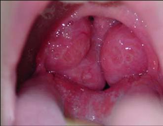 tonsillitis adenitis homeopathy treatment in chennai. velacheri, tamil nadu