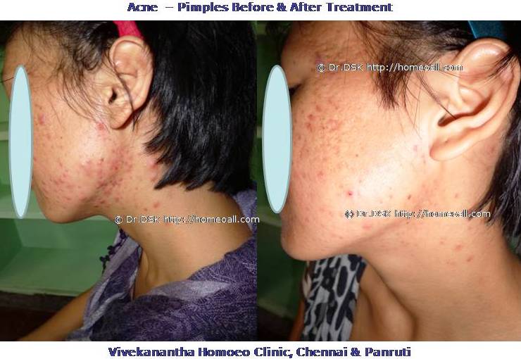 Pimples Acne Homeopathy Specialty treatment Dr.Senthil Kumar, Vivekanantha homeopathy clinic, Velachery, Chennai, Panruti, pondichery, Cuddalore முகப்பரு (Acne / Pimples) முகப்பரு எதனால் உண்டாகிறது? தோலில் ஒவ்வொரு முடி வேர்காலிலும் (Hair Follicle) உள்ள செபம் (Sebum) எனப்படும் எண்ணை தண்மையுள்ள பொருளைச் சுரக்கும் சுரப்பியால் தோலானது ஈரத்தன்மையை பெறுகிறது. இந்த சுரப்பியில் அடைப்போ, நோய்த்தொற்றோ ஏற்படும்போது முகப்பரு உண்டாகிறது. முகப்பரு வகைகள் வெண் பருக்கள்(White Heads) • ஆண் பெண் இருவரும் பருவமடையும் வயதை எட்டும்போதும் பருவமடைந்த பின்னும் செபம் எண்ணை உற்பத்தி அதிகரித்து முடி வேர்க்கால்கள் மற்றும் தோலில் உள்ள நுண்துளைகள், செபத்தால் நிரப்பப்படும். இதன் விளைவாக பரு (White Head) ஏற்படுகிறது. கரும் பருக்கள்(Black Heads) • செபத்தால் அடைக்கப்பட்ட முடி வேர்க்கால் மற்றும் நுண்துளைகள் திறந்ததும் Black Head' ஆகக் காணப்படும். முடி வேர்க்கால்களிலுள்ள பேக்டீரியாக்கள் செபத்துடன் கலந்து நோய் தொற்றை ஏற்படுத்துவதன் விளைவாக, சிவப்பான, வலியுடன் கூடிய முகப்பருக்கள் ஏற்படுகின்றன. சில சமயங்களில் சீழ் உண்டாகி, நோட்ஸ் (Nodes), சிஸ்ட்ஸ் (Cysts) எனப்படும், பெரும் வலியுடன் கூடிய வீக்கங்களாக மாறும். இதன் விளைவாக குழிகளோடு அல்லது தழும்பு போன்ற வடுக்கள் உண்டாகும். பருக்கள் தோன்றும் இடங்கள் பருக்கள் ஒன்றாகவோ அல்லது திட்டுத்திட்டாகவோ ஏற்படலாம். அவை அதிகமாக வரும் இடங்கள். • முகம் • கழுத்து • நெஞ்சு • முதுகு • தோல்பட்டைகள் யாருக்கு முகப்பருக்கள் அதிகம் வரும்? • முகப் பருக்கள் 13-19 (Teen Age) வயதுக்கு உட்பட்ட வாலிப வயதினரைப் பாதிக்கும். 12-18 வயதுக்குட்பட்ட வாலிப வயதினர்களில் 85%, ஏதோ ஒரு வித வகையில் முகப்பருக்களால் பாதிக்கப்படுகின்றனர். • முகப்பருக்கள் 20, 30 வயதுகளில்கூட தோன்றத் தொடங்கலாம். 10% முதல் 20% பெரியவர்கள் கூட இதனால் பாதிக்கப்படுகின்றனர். • பருக்கள் இளம்பெண்கள் மற்றும் ஆண்களிடம் அதிகமாக காணப்படும், காரணம் செக்ஸ் ஹார்மோன்கள் சீபத்தை அதிக அளவு சுரக்கச் செய்யும். பருக்கள் ஏற்படக்காரணங்கள் • குடும்பத்தில் யாருக்காவது பரு இருத்தல் • ஹார்மோன் மாறுபாடு- பூப்படையும் காலத்தை எட்டும்போது அதிக அளவு வரும். • மன உளைச்சல் • சில மருந்துகளை தொடர்ந்து உட்கொள்வதால் (லித்தியம்(lithium) பார்புட்ரேட்ஸ்(barbiturates) அண்ரோஜன்ஸ்(androgens) அயோடீன்(Iodines)) முகப்பருவை மேலும் மோசமாக்கும் காரணக் கூறுகள் • பிசுபிசுப்பு தண்மையுள்ள அழகு சாதனங்கள், • பிசுபிசுப்பு தண்மையுள்ள கூந்தல் எண்ணை, ஜெல்வகைகள் முகப் பருக்களை மேலும் மோசமாக்கும். எனவே தண்ணீரில் கரையக்கூடிய, எண்ணை இல்லாத அழகு சாதனங்களையே பயன்படுத்துங்கள். • சாக்லெட்டுக்கள், எண்ணெய் பயன்படுத்தி செய்யப்படும் உணவுப்பொருட்கள் முகப்பருக்களை அதிகரிக்கச் செய்யும் என்பதற்கான அறிவியல் பூர்வ சான்றுகள் ஏதுமில்லை. இருந்தாலும் எண்ணை உணவுவகைகள் அதிகம் உட்கொள்வது நல்லதல்ல, முகப்பருக்களுக்கான மருத்துவம் மருத்துவரின் ஆலோசனைப்படி மருத்துவம் பெற்றால் முகப்பருக்களின் வடுக்கள் ஏற்படாவண்ணம் தடுத்து, உங்கள் தோற்றத்தை மேம்படுத்திக்கொள்ளலாம். ஆரம்பநிலையில் உள்ள முகப்பருக்கள், வழக்கமாக, தோலின்மேல் பூசும் கிரீம், லோஷன், ஜெல்களினாலே குறைந்துவிடும். இந்தத் தயாரிப்புகள் தோலைச் செம்மை நிறமாகவும், ஈரப் பசையற்றதாகவும், மென்மையாக்கும். ஆனால் இந்தப் பலன்கள் தற்காலிகமானவை. மிகவும் தீவிர நிலையிலுள்ள முகப்பருக்களைப் போக்க, ஆண்ட்டி பயாடிக்குகள் உதவும். இவற்றைக் குறைந்தது 4-6 மாதங்கள் பயன்படுத்த வேண்டியிருக்கும். தொடர்ந்து ஆண்ட்டி பயாடிக் பயன்படுத்துவது பின்விளைவுகளையும் பக்க விளைவுகளையும் ஏற்படுத்தும். எல்லாவித மருத்துவங்களும் சிறிது விளைவுகளைக் காட்ட குறைந்தது 4-6 வாரங்கள் பிடிக்கும். எனவே மருந்துகளை இடையிலேயே மனமுடைந்து நிறுத்தி விடாமல் தொடருங்கள். வெண்பருக்களும் கரும் பருக்களும் காலப்போக்கில் சரியாகிவிடும். எனினும் அவற்றை தொடர்ந்து தொடுவதலோ, சொறிந்தலோ அல்லது கிள்ளுவதாலோ பருக்கள் வீக்கமடைந்து, ஒரு நிரந்தர வடுவை விட்டு விடும். தொடர்ச்சியாக முகம் கழுவுவதால் நுன்துளைகள் அடைந்து விடும். முகத்தை ஒரு நாளைக்கு இரண்டு தடவைக்கு மேல் சோப் உபயோகித்து கழுவக்கூடாது. கழுவும் போது மெதுவாக வெறும் கைகளால் கழுவ வேண்டும். அழுக்கு, தூசு படிதல் அல்லது முகம் கழுவாமல் இருத்தல் போன்றவை பருக்களை அதிகரிக்கும். மன உளைச்சல் பருக்களை அதிகரிக்கும். மன உளைச்சல் ஹார்மோன்களில் மாற்றத்தை ஏற்படுத்தி பருக்கள் உருவாவதை அதிகரிக்கும்.எனவே மன உளைச்சளை தவிர்த்தல் நல்லது. அப்படியும் பருக்கள் குறையவில்லை என்றால் தயங்காது தாமதிக்காது ஹோமியோபதி மருத்துவரை கலந்தாலோசித்து தகுந்த சிகிச்சையும் ஆலோசனையும் பெற்றால் நல்ல பலனை பெறலாம். முகப்பருக்கான ஹோமியோபதி மருத்துவம். நோயின் அறிகுறிகளுக்கேற்ற ஹோமியோபதி மருந்துகள் பாதுகாப்பாக பக்கவிளைவுகள் இல்லாமல் முகப்பருக்களிலிருந்து நல்ல பலனை தரும். முகப்பரு சிகிச்சைக்கு தொடர்பு கொள்ளவும் சிறப்பு மருத்துவர் செந்தில் குமார் தண்டபாணி அவர்களிடம் இதைப்போன்ற முகப்பரு பிரச்சினைகளுக்கு அலோசனை & சிகிச்சை பெற்று பலர் நல்ல பலனடைந்திருக்கிறார்கள். மருத்துவர் செந்தில் குமார் அவர்களை சென்னை, வேளச்சேரி விவேகானந்தா ஹோமியோபதி கிளினிக் & உளவியல் ஆலோசனை மையத்தில் சந்திக்கலாம். முன்பதிவு அவசியம். முன்பதிவிற்கு தொடர்புகொள்ளவும் 9786901830, மின் அஞ்சல்: consult.ur.dr@gmail.com மேலும் விபரங்களுக்கும் ஆலோசனைக்கும் சிகிச்சைக்கும் தொடர்பு கொள்க விவேகானந்தா கிளினிக் ஆலோசனை மையங்கள் & தொடர்பு எண்கள் சென்னை:- 9786901830 பண்ருட்டி:- 9443054168 புதுச்சேரி:- 9865212055 (Camp) மின் அஞ்சல் : consult.ur.dr@gmail.com, homoeokumar@gmail.com முன்பதிவிற்கு அழைக்கவும் அல்லது மின் அஞ்சல் அனுப்பவும். முன்பதிவிற்கு: உங்களின் பெயர் - வயது – அலைபேசி எண் – பிரச்சனை (ஒரு வரியில்) தேதி – கிழமை – இடம், முதலியவற்றை குறுந்தகவல் மூலம் அனுப்பவும். உதாரணம்: ரம்யா - 28 – 99******00 – குழந்தையின்மை – 20-12-2013 – சனிக்கிழமை – சென்னை, மருத்துவர் உங்களின் முன்பதிவை குறுந்தகவல் மூலம் உறுதிப்படுத்துவார்.