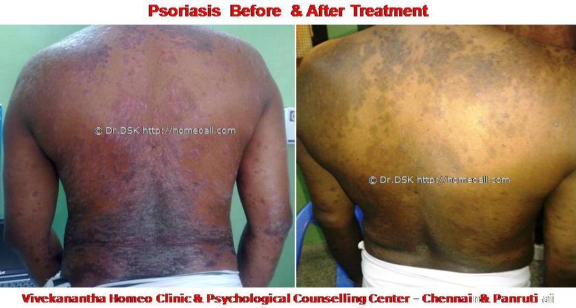Psoriasis Homeopathy Specialty treatment Dr.Senthil Kumar, Vivekanantha homeopathy clinic, Velachery, Chennai, Panruti, pondichery, Cuddalore Psoriasis - சொரியாசிஸ் சொரியாசிஸ் - Psoriasis என்றால் என்ன ? சொரியாசிஸ் என்பது தோல் அழற்சி நிலையாகும். இதை மீன் செதில் படை என்றும் அழைக்கலாம். சொரியாசிஸ் தோலில் உள்ள செல்கள் வேகமாக இறப்பதன் மூலம் உண்டாகிறது. இதன் விளைவாக தோல் தடித்து மீன் செதில் போன்று இறந்த செல்கள் உதிரும், புரையோடும். தோலிலுள்ள பல சிறு இரத்த நாளங்கள் வீங்கிவிடுவதால் தோல் சிவப்பு நிறமாகக் காணப்படும். சொரியாசிஸ் எவ்வாறு தோற்றமளிக்கும்? • சொரியாசிஸ் என்பது தோலில், மீன் செதில் போன்று இறந்த செல்கள் உதிர்ந்து விழும் புரையுடன் கூடிய வெண்மை / சிவப்பு திட்டுகளாக (Silver Scaly patches) காணப்படும். • உடலின் எந்தப்பாகத்தில் வேண்டுமானாலும் வரலாம். • முழங்கை, முழுங்கால் மூட்டு, முதுகு, தலையுச்சி முதலிய பாகங்கள் பொதுவாக பாதிக்கப்படும். சொரியாசிஸ் தொற்று நோயா? • சொரியாசிஸ் தொற்று நோயல்ல. இது மற்றவர்களுக்கு பரவாது • சுகாதார குறைவு காரணமாக இது ஏற்படாது. சொரியாசிஸ் வர காரணம் என்ன ? • சொரியாசிஸ் மரபு காரணம் மற்றும் சுற்றுச் சூழல் நிலை இவற்றின் பாதிப்பினால் ஏற்படுகிறது என்று நம்பப்படுகிறது. • சொரியாசிஸால் பாதிக்கப்படுபவர்களில் 25% பேர் சொரியாசிஸ் நோயுடைய குடும்பத்திலிருந்து வந்தவர்களே, சிலருக்கு மரபு நிலை காரணமாகிறது. • உடல், மன அழுத்தங்கள், குரல்வளை தொற்று, ப்ளூ, ஸ்டீராய்ட் ஹார்மோன்ஸ், சில ஆண்ட்டி ஹைபர் டென்சிவ் போன்ற சில மருந்துகள், சோரியாசிஸை மேலும் மோசமாக்கும். • குடிபழக்கம், புகைபிடித்தல் சொரியாசிஸை மோசமாக்கும். சொரியாசிஸ் நோயின் விளைவுகள் • சொரியாசிஸ் நோயாளிகளுக்கு மூட்டுவலிகளும், வீக்கமும் வரலாம். • சொரியாசிஸ் விரல்களையும், கால்விரல் நகங்களையும் தாக்கி, சிறு குழிகளையும், கருமை நிறத்தையும், நகங்கள் தடிப்பையும், ஏற்படுத்தும். நகம் உடையலாம். சொரியாசிஸ் யாருக்கு வரும் ? • சொரியாசிஸ் ஆண், பெண் இருவரையும் சமமாகத் தாக்கலாம். • சொரியாசிஸ் எந்த வயதில் வேண்டுமானாலும் வரலாம். வழக்கமாக 20 வது வயதில் தாக்கத் தொடங்கும். பிறப்பிலிருந்தும் முதிய வயதிலும் கூட இது வரலாம். • ஒரு முறை சொரியாசிஸ் வந்ததும், குறைதல், தணிதல், அதிகரித்தல் என பல்வேறு நிலை மாற்றங்கள் ஏற்படும். சொரியாசிஸ்க்கு என்ன மருத்துவங்கள் உள்ளன. நவீன மருத்துவத்தில் பல மருந்துகள் உபயோகப்படுத்தப்படுகின்றன, டாபிகல் ஸ்டீராய்ட்ஸ் மேற்பூச்சுக்கள் (Steroids creams), போட்டோதெரபி, அல்ட்ரா வைலட், மெதாட்டுரக்ஸாட் (methotrexate) இத்தகைய மருந்துகள் பக்க விளைவுகளை ஏற்படுத்தும். எனவே நோயாளிகள் இந்தப் பக்க விளைவுகளைப் பரிசோதித்துக் கொள்ள அடிக்கடி இரத்த பரிசோதனை செய்து கொள்ள வேண்டும். மேலும் தொடர்ந்து இந்த மருந்துகளை உட்கொள்ளக்கூடாது. சொரியாசிஸ் நோயாளிகள் செய்யக்கூடாதவை, செய்ய வேண்டியவை  தோலைச் சொரியாதீர்கள் ஏனெனில் இது குணமாவதைத் தாமதப்படுத்தும்.  ஹோமியோபதி மருந்துகள் வேலை செய்து விளைவுகள் காட்ட பல வாரங்கள் ஆகுமாதலால் மருத்துவத்தை விரைவில், இடையில் நிறுத்திவிடாதீர்கள்.  சொரியாசிஸைக் கட்டுப்படுத்த தரப்பட்ட மருந்துகளையும், மருத்துவத்தையும் திடீரென்று நிறுத்திவிடாதீர்கள். இதனால் நோய் இன்னும் மோசமாகும்.  மருந்துகளை தொடர்ந்து சீராக எடுத்துக்கொள்ளுங்கள்.  தோலை எப்போதும் ஈரத்தன்மையுடையதாக வைத்திருங்கள். அது நமைச்சலையும், அரிப்பையும், புரை ஏற்படுவதையும் தடுக்கும்.  சூரிய ஒளியில் இருப்பது பொதுவாக நல்லதே, ஆனால் அதிகமாக வெகு நேரம் இருப்பதால் வேர்க்குருக்கள் உண்டாகும். அதனால் சொரியாசிஸ் தீவிரமடையும்.  மன அழுத்தம் சொரியாசிஸை அதிகப்படுத்தும். அமைதியாக இருக்கவும், உடற்பயிற்சி செய்யவும், ஒய்வு எடுத்துக்கொள்ளவும், சோரியாஸிஸ் ஹோமியோபதி மருத்துவ சிகிச்சை, நோயின் அறிகுறிகளுக்கேற்ற ஹோமியோபதி மருத்துவசிகிச்சை நோயின் தன்மையை நன்கு கட்டுப்படுத்தி விரைவில் நல்ல பலனளிக்கும். தொடர்ந்து ஹோமியோபதி மருந்துகளை உட்கொள்வதன் மூலம் நல்ல பலன்பெறலாம். ஹோமியோபதி சிகிச்சைக்கு தொடர்பு கொள்ளவும் ஹோமியோபதி சிறப்பு மருத்துவர் செந்தில் குமார் தண்டபாணி அவர்களிடம் இதைப்போன்ற நோய்களுக்கு சிகிச்சை பெற்று பலர் நல்ல பலனடைந்திருக்கிறார்கள். மருத்துவர் செந்தில் குமார் அவர்களை சென்னை, வேளச்சேரி விவேகானந்தா ஹோமியோபதி கிளினிக் & உளவியல் ஆலோசனை மையத்தில் சந்திக்கலாம். முன்பதிவு அவசியம். முன்பதிவிற்கு தொடர்புகொள்ளவும் 9786901830, மின் அஞ்சல்: consult.ur.dr@gmail.com மேலும் விபரங்களுக்கும் ஆலோசனைக்கும் சிகிச்சைக்கும் தொடர்பு கொள்க விவேகானந்தா கிளினிக் ஆலோசனை மையங்கள் & தொடர்பு எண்கள் சென்னை:- 9786901830 பண்ருட்டி:- 9443054168 புதுச்சேரி:- 9865212055 (Camp) மின் அஞ்சல் : consult.ur.dr@gmail.com, homoeokumar@gmail.com முன்பதிவிற்கு அழைக்கவும் அல்லது மின் அஞ்சல் அனுப்பவும். முன்பதிவிற்கு: உங்களின் பெயர் - வயது – அலைபேசி எண் – பிரச்சனை (ஒரு வரியில்) தேதி – கிழமை – இடம், முதலியவற்றை குறுந்தகவல் மூலம் அனுப்பவும். உதாரணம்: ரம்யா - 28 – 99******00 – சோரியாசிஸ் Psoriasis – 20-12-2014 – சனிக்கிழமை – சென்னை, மருத்துவர் உங்களின் முன்பதிவை குறுந்தகவல் மூலம் உறுதிப்படுத்துவார்.