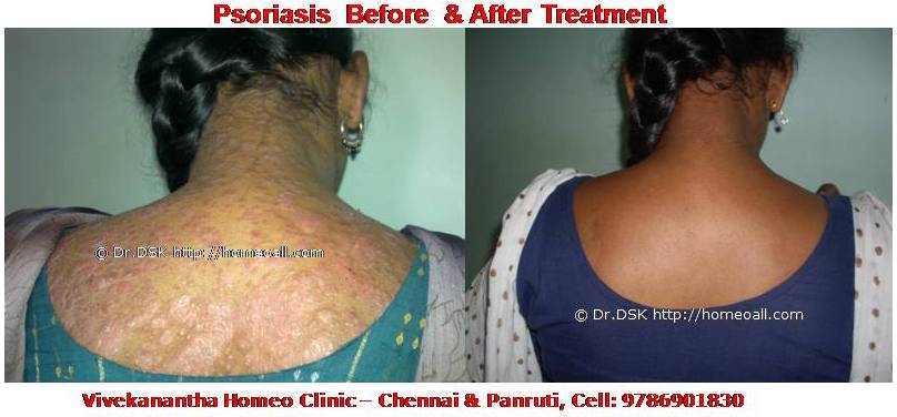 Psoriasis Homeopathy Specialty treatment Dr.Senthil Kumar, Vivekanantha homeopathy clinic, Velachery, Chennai, Panruti, pondichery, Cuddalore (10) Psoriasis - சொரியாசிஸ் சொரியாசிஸ் - Psoriasis என்றால் என்ன ? சொரியாசிஸ் என்பது தோல் அழற்சி நிலையாகும். இதை மீன் செதில் படை என்றும் அழைக்கலாம். சொரியாசிஸ் தோலில் உள்ள செல்கள் வேகமாக இறப்பதன் மூலம் உண்டாகிறது. இதன் விளைவாக தோல் தடித்து மீன் செதில் போன்று இறந்த செல்கள் உதிரும், புரையோடும். தோலிலுள்ள பல சிறு இரத்த நாளங்கள் வீங்கிவிடுவதால் தோல் சிவப்பு நிறமாகக் காணப்படும். சொரியாசிஸ் எவ்வாறு தோற்றமளிக்கும்? • சொரியாசிஸ் என்பது தோலில், மீன் செதில் போன்று இறந்த செல்கள் உதிர்ந்து விழும் புரையுடன் கூடிய வெண்மை / சிவப்பு திட்டுகளாக (Silver Scaly patches) காணப்படும். • உடலின் எந்தப்பாகத்தில் வேண்டுமானாலும் வரலாம். • முழங்கை, முழுங்கால் மூட்டு, முதுகு, தலையுச்சி முதலிய பாகங்கள் பொதுவாக பாதிக்கப்படும். சொரியாசிஸ் தொற்று நோயா? • சொரியாசிஸ் தொற்று நோயல்ல. இது மற்றவர்களுக்கு பரவாது • சுகாதார குறைவு காரணமாக இது ஏற்படாது. சொரியாசிஸ் வர காரணம் என்ன ? • சொரியாசிஸ் மரபு காரணம் மற்றும் சுற்றுச் சூழல் நிலை இவற்றின் பாதிப்பினால் ஏற்படுகிறது என்று நம்பப்படுகிறது. • சொரியாசிஸால் பாதிக்கப்படுபவர்களில் 25% பேர் சொரியாசிஸ் நோயுடைய குடும்பத்திலிருந்து வந்தவர்களே, சிலருக்கு மரபு நிலை காரணமாகிறது. • உடல், மன அழுத்தங்கள், குரல்வளை தொற்று, ப்ளூ, ஸ்டீராய்ட் ஹார்மோன்ஸ், சில ஆண்ட்டி ஹைபர் டென்சிவ் போன்ற சில மருந்துகள், சோரியாசிஸை மேலும் மோசமாக்கும். • குடிபழக்கம், புகைபிடித்தல் சொரியாசிஸை மோசமாக்கும். சொரியாசிஸ் நோயின் விளைவுகள் • சொரியாசிஸ் நோயாளிகளுக்கு மூட்டுவலிகளும், வீக்கமும் வரலாம். • சொரியாசிஸ் விரல்களையும், கால்விரல் நகங்களையும் தாக்கி, சிறு குழிகளையும், கருமை நிறத்தையும், நகங்கள் தடிப்பையும், ஏற்படுத்தும். நகம் உடையலாம். சொரியாசிஸ் யாருக்கு வரும் ? • சொரியாசிஸ் ஆண், பெண் இருவரையும் சமமாகத் தாக்கலாம். • சொரியாசிஸ் எந்த வயதில் வேண்டுமானாலும் வரலாம். வழக்கமாக 20 வது வயதில் தாக்கத் தொடங்கும். பிறப்பிலிருந்தும் முதிய வயதிலும் கூட இது வரலாம். • ஒரு முறை சொரியாசிஸ் வந்ததும், குறைதல், தணிதல், அதிகரித்தல் என பல்வேறு நிலை மாற்றங்கள் ஏற்படும். சொரியாசிஸ்க்கு என்ன மருத்துவங்கள் உள்ளன. நவீன மருத்துவத்தில் பல மருந்துகள் உபயோகப்படுத்தப்படுகின்றன, டாபிகல் ஸ்டீராய்ட்ஸ் மேற்பூச்சுக்கள் (Steroids creams), போட்டோதெரபி, அல்ட்ரா வைலட், மெதாட்டுரக்ஸாட் (methotrexate) இத்தகைய மருந்துகள் பக்க விளைவுகளை ஏற்படுத்தும். எனவே நோயாளிகள் இந்தப் பக்க விளைவுகளைப் பரிசோதித்துக் கொள்ள அடிக்கடி இரத்த பரிசோதனை செய்து கொள்ள வேண்டும். மேலும் தொடர்ந்து இந்த மருந்துகளை உட்கொள்ளக்கூடாது. சொரியாசிஸ் நோயாளிகள் செய்யக்கூடாதவை, செய்ய வேண்டியவை  தோலைச் சொரியாதீர்கள் ஏனெனில் இது குணமாவதைத் தாமதப்படுத்தும்.  ஹோமியோபதி மருந்துகள் வேலை செய்து விளைவுகள் காட்ட பல வாரங்கள் ஆகுமாதலால் மருத்துவத்தை விரைவில், இடையில் நிறுத்திவிடாதீர்கள்.  சொரியாசிஸைக் கட்டுப்படுத்த தரப்பட்ட மருந்துகளையும், மருத்துவத்தையும் திடீரென்று நிறுத்திவிடாதீர்கள். இதனால் நோய் இன்னும் மோசமாகும்.  மருந்துகளை தொடர்ந்து சீராக எடுத்துக்கொள்ளுங்கள்.  தோலை எப்போதும் ஈரத்தன்மையுடையதாக வைத்திருங்கள். அது நமைச்சலையும், அரிப்பையும், புரை ஏற்படுவதையும் தடுக்கும்.  சூரிய ஒளியில் இருப்பது பொதுவாக நல்லதே, ஆனால் அதிகமாக வெகு நேரம் இருப்பதால் வேர்க்குருக்கள் உண்டாகும். அதனால் சொரியாசிஸ் தீவிரமடையும்.  மன அழுத்தம் சொரியாசிஸை அதிகப்படுத்தும். அமைதியாக இருக்கவும், உடற்பயிற்சி செய்யவும், ஒய்வு எடுத்துக்கொள்ளவும், சோரியாஸிஸ் ஹோமியோபதி மருத்துவ சிகிச்சை, நோயின் அறிகுறிகளுக்கேற்ற ஹோமியோபதி மருத்துவசிகிச்சை நோயின் தன்மையை நன்கு கட்டுப்படுத்தி விரைவில் நல்ல பலனளிக்கும். தொடர்ந்து ஹோமியோபதி மருந்துகளை உட்கொள்வதன் மூலம் நல்ல பலன்பெறலாம். ஹோமியோபதி சிகிச்சைக்கு தொடர்பு கொள்ளவும் ஹோமியோபதி சிறப்பு மருத்துவர் செந்தில் குமார் தண்டபாணி அவர்களிடம் இதைப்போன்ற நோய்களுக்கு சிகிச்சை பெற்று பலர் நல்ல பலனடைந்திருக்கிறார்கள். மருத்துவர் செந்தில் குமார் அவர்களை சென்னை, வேளச்சேரி விவேகானந்தா ஹோமியோபதி கிளினிக் & உளவியல் ஆலோசனை மையத்தில் சந்திக்கலாம். முன்பதிவு அவசியம். முன்பதிவிற்கு தொடர்புகொள்ளவும் 9786901830, மின் அஞ்சல்: consult.ur.dr@gmail.com மேலும் விபரங்களுக்கும் ஆலோசனைக்கும் சிகிச்சைக்கும் தொடர்பு கொள்க விவேகானந்தா கிளினிக் ஆலோசனை மையங்கள் & தொடர்பு எண்கள் சென்னை:- 9786901830 பண்ருட்டி:- 9443054168 புதுச்சேரி:- 9865212055 (Camp) மின் அஞ்சல் : consult.ur.dr@gmail.com, homoeokumar@gmail.com முன்பதிவிற்கு அழைக்கவும் அல்லது மின் அஞ்சல் அனுப்பவும். முன்பதிவிற்கு: உங்களின் பெயர் - வயது – அலைபேசி எண் – பிரச்சனை (ஒரு வரியில்) தேதி – கிழமை – இடம், முதலியவற்றை குறுந்தகவல் மூலம் அனுப்பவும். உதாரணம்: ரம்யா - 28 – 99******00 – சோரியாசிஸ் Psoriasis – 20-12-2014 – சனிக்கிழமை – சென்னை, மருத்துவர் உங்களின் முன்பதிவை குறுந்தகவல் மூலம் உறுதிப்படுத்துவார்.