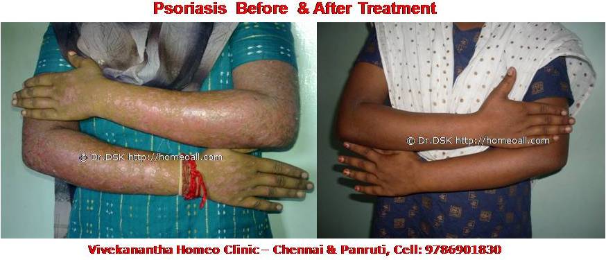Psoriasis Homeopathy Specialty treatment Dr.Senthil Kumar, Vivekanantha homeopathy clinic, Velachery, Chennai, Panruti, pondichery, Cuddalore (11) Psoriasis - சொரியாசிஸ் சொரியாசிஸ் - Psoriasis என்றால் என்ன ? சொரியாசிஸ் என்பது தோல் அழற்சி நிலையாகும். இதை மீன் செதில் படை என்றும் அழைக்கலாம். சொரியாசிஸ் தோலில் உள்ள செல்கள் வேகமாக இறப்பதன் மூலம் உண்டாகிறது. இதன் விளைவாக தோல் தடித்து மீன் செதில் போன்று இறந்த செல்கள் உதிரும், புரையோடும். தோலிலுள்ள பல சிறு இரத்த நாளங்கள் வீங்கிவிடுவதால் தோல் சிவப்பு நிறமாகக் காணப்படும். சொரியாசிஸ் எவ்வாறு தோற்றமளிக்கும்? • சொரியாசிஸ் என்பது தோலில், மீன் செதில் போன்று இறந்த செல்கள் உதிர்ந்து விழும் புரையுடன் கூடிய வெண்மை / சிவப்பு திட்டுகளாக (Silver Scaly patches) காணப்படும். • உடலின் எந்தப்பாகத்தில் வேண்டுமானாலும் வரலாம். • முழங்கை, முழுங்கால் மூட்டு, முதுகு, தலையுச்சி முதலிய பாகங்கள் பொதுவாக பாதிக்கப்படும். சொரியாசிஸ் தொற்று நோயா? • சொரியாசிஸ் தொற்று நோயல்ல. இது மற்றவர்களுக்கு பரவாது • சுகாதார குறைவு காரணமாக இது ஏற்படாது. சொரியாசிஸ் வர காரணம் என்ன ? • சொரியாசிஸ் மரபு காரணம் மற்றும் சுற்றுச் சூழல் நிலை இவற்றின் பாதிப்பினால் ஏற்படுகிறது என்று நம்பப்படுகிறது. • சொரியாசிஸால் பாதிக்கப்படுபவர்களில் 25% பேர் சொரியாசிஸ் நோயுடைய குடும்பத்திலிருந்து வந்தவர்களே, சிலருக்கு மரபு நிலை காரணமாகிறது. • உடல், மன அழுத்தங்கள், குரல்வளை தொற்று, ப்ளூ, ஸ்டீராய்ட் ஹார்மோன்ஸ், சில ஆண்ட்டி ஹைபர் டென்சிவ் போன்ற சில மருந்துகள், சோரியாசிஸை மேலும் மோசமாக்கும். • குடிபழக்கம், புகைபிடித்தல் சொரியாசிஸை மோசமாக்கும். சொரியாசிஸ் நோயின் விளைவுகள் • சொரியாசிஸ் நோயாளிகளுக்கு மூட்டுவலிகளும், வீக்கமும் வரலாம். • சொரியாசிஸ் விரல்களையும், கால்விரல் நகங்களையும் தாக்கி, சிறு குழிகளையும், கருமை நிறத்தையும், நகங்கள் தடிப்பையும், ஏற்படுத்தும். நகம் உடையலாம். சொரியாசிஸ் யாருக்கு வரும் ? • சொரியாசிஸ் ஆண், பெண் இருவரையும் சமமாகத் தாக்கலாம். • சொரியாசிஸ் எந்த வயதில் வேண்டுமானாலும் வரலாம். வழக்கமாக 20 வது வயதில் தாக்கத் தொடங்கும். பிறப்பிலிருந்தும் முதிய வயதிலும் கூட இது வரலாம். • ஒரு முறை சொரியாசிஸ் வந்ததும், குறைதல், தணிதல், அதிகரித்தல் என பல்வேறு நிலை மாற்றங்கள் ஏற்படும். சொரியாசிஸ்க்கு என்ன மருத்துவங்கள் உள்ளன. நவீன மருத்துவத்தில் பல மருந்துகள் உபயோகப்படுத்தப்படுகின்றன, டாபிகல் ஸ்டீராய்ட்ஸ் மேற்பூச்சுக்கள் (Steroids creams), போட்டோதெரபி, அல்ட்ரா வைலட், மெதாட்டுரக்ஸாட் (methotrexate) இத்தகைய மருந்துகள் பக்க விளைவுகளை ஏற்படுத்தும். எனவே நோயாளிகள் இந்தப் பக்க விளைவுகளைப் பரிசோதித்துக் கொள்ள அடிக்கடி இரத்த பரிசோதனை செய்து கொள்ள வேண்டும். மேலும் தொடர்ந்து இந்த மருந்துகளை உட்கொள்ளக்கூடாது. சொரியாசிஸ் நோயாளிகள் செய்யக்கூடாதவை, செய்ய வேண்டியவை  தோலைச் சொரியாதீர்கள் ஏனெனில் இது குணமாவதைத் தாமதப்படுத்தும்.  ஹோமியோபதி மருந்துகள் வேலை செய்து விளைவுகள் காட்ட பல வாரங்கள் ஆகுமாதலால் மருத்துவத்தை விரைவில், இடையில் நிறுத்திவிடாதீர்கள்.  சொரியாசிஸைக் கட்டுப்படுத்த தரப்பட்ட மருந்துகளையும், மருத்துவத்தையும் திடீரென்று நிறுத்திவிடாதீர்கள். இதனால் நோய் இன்னும் மோசமாகும்.  மருந்துகளை தொடர்ந்து சீராக எடுத்துக்கொள்ளுங்கள்.  தோலை எப்போதும் ஈரத்தன்மையுடையதாக வைத்திருங்கள். அது நமைச்சலையும், அரிப்பையும், புரை ஏற்படுவதையும் தடுக்கும்.  சூரிய ஒளியில் இருப்பது பொதுவாக நல்லதே, ஆனால் அதிகமாக வெகு நேரம் இருப்பதால் வேர்க்குருக்கள் உண்டாகும். அதனால் சொரியாசிஸ் தீவிரமடையும்.  மன அழுத்தம் சொரியாசிஸை அதிகப்படுத்தும். அமைதியாக இருக்கவும், உடற்பயிற்சி செய்யவும், ஒய்வு எடுத்துக்கொள்ளவும், சோரியாஸிஸ் ஹோமியோபதி மருத்துவ சிகிச்சை, நோயின் அறிகுறிகளுக்கேற்ற ஹோமியோபதி மருத்துவசிகிச்சை நோயின் தன்மையை நன்கு கட்டுப்படுத்தி விரைவில் நல்ல பலனளிக்கும். தொடர்ந்து ஹோமியோபதி மருந்துகளை உட்கொள்வதன் மூலம் நல்ல பலன்பெறலாம். ஹோமியோபதி சிகிச்சைக்கு தொடர்பு கொள்ளவும் ஹோமியோபதி சிறப்பு மருத்துவர் செந்தில் குமார் தண்டபாணி அவர்களிடம் இதைப்போன்ற நோய்களுக்கு சிகிச்சை பெற்று பலர் நல்ல பலனடைந்திருக்கிறார்கள். மருத்துவர் செந்தில் குமார் அவர்களை சென்னை, வேளச்சேரி விவேகானந்தா ஹோமியோபதி கிளினிக் & உளவியல் ஆலோசனை மையத்தில் சந்திக்கலாம். முன்பதிவு அவசியம். முன்பதிவிற்கு தொடர்புகொள்ளவும் 9786901830, மின் அஞ்சல்: consult.ur.dr@gmail.com மேலும் விபரங்களுக்கும் ஆலோசனைக்கும் சிகிச்சைக்கும் தொடர்பு கொள்க விவேகானந்தா கிளினிக் ஆலோசனை மையங்கள் & தொடர்பு எண்கள் சென்னை:- 9786901830 பண்ருட்டி:- 9443054168 புதுச்சேரி:- 9865212055 (Camp) மின் அஞ்சல் : consult.ur.dr@gmail.com, homoeokumar@gmail.com முன்பதிவிற்கு அழைக்கவும் அல்லது மின் அஞ்சல் அனுப்பவும். முன்பதிவிற்கு: உங்களின் பெயர் - வயது – அலைபேசி எண் – பிரச்சனை (ஒரு வரியில்) தேதி – கிழமை – இடம், முதலியவற்றை குறுந்தகவல் மூலம் அனுப்பவும். உதாரணம்: ரம்யா - 28 – 99******00 – சோரியாசிஸ் Psoriasis – 20-12-2014 – சனிக்கிழமை – சென்னை, மருத்துவர் உங்களின் முன்பதிவை குறுந்தகவல் மூலம் உறுதிப்படுத்துவார்.