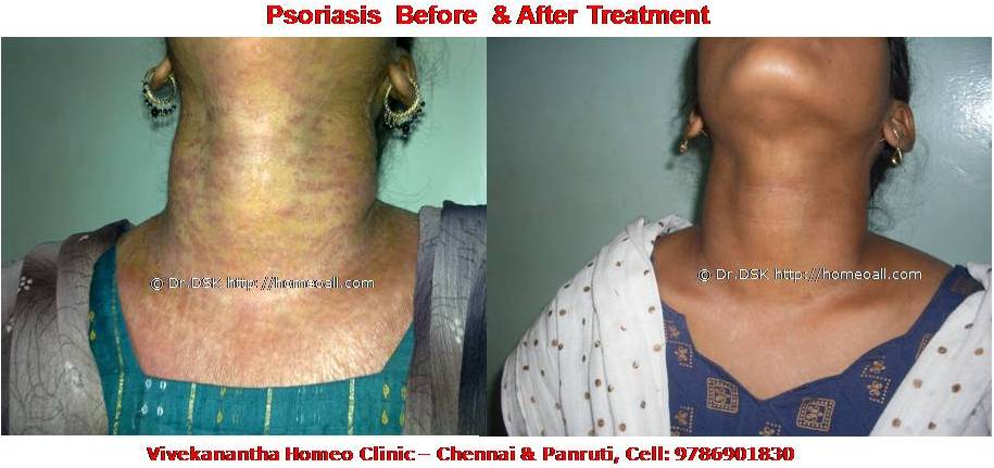 Psoriasis Homeopathy Specialty treatment Dr.Senthil Kumar, Vivekanantha homeopathy clinic, Velachery, Chennai, Panruti, pondichery, Cuddalore (13) Psoriasis - சொரியாசிஸ் சொரியாசிஸ் - Psoriasis என்றால் என்ன ? சொரியாசிஸ் என்பது தோல் அழற்சி நிலையாகும். இதை மீன் செதில் படை என்றும் அழைக்கலாம். சொரியாசிஸ் தோலில் உள்ள செல்கள் வேகமாக இறப்பதன் மூலம் உண்டாகிறது. இதன் விளைவாக தோல் தடித்து மீன் செதில் போன்று இறந்த செல்கள் உதிரும், புரையோடும். தோலிலுள்ள பல சிறு இரத்த நாளங்கள் வீங்கிவிடுவதால் தோல் சிவப்பு நிறமாகக் காணப்படும். சொரியாசிஸ் எவ்வாறு தோற்றமளிக்கும்? • சொரியாசிஸ் என்பது தோலில், மீன் செதில் போன்று இறந்த செல்கள் உதிர்ந்து விழும் புரையுடன் கூடிய வெண்மை / சிவப்பு திட்டுகளாக (Silver Scaly patches) காணப்படும். • உடலின் எந்தப்பாகத்தில் வேண்டுமானாலும் வரலாம். • முழங்கை, முழுங்கால் மூட்டு, முதுகு, தலையுச்சி முதலிய பாகங்கள் பொதுவாக பாதிக்கப்படும். சொரியாசிஸ் தொற்று நோயா? • சொரியாசிஸ் தொற்று நோயல்ல. இது மற்றவர்களுக்கு பரவாது • சுகாதார குறைவு காரணமாக இது ஏற்படாது. சொரியாசிஸ் வர காரணம் என்ன ? • சொரியாசிஸ் மரபு காரணம் மற்றும் சுற்றுச் சூழல் நிலை இவற்றின் பாதிப்பினால் ஏற்படுகிறது என்று நம்பப்படுகிறது. • சொரியாசிஸால் பாதிக்கப்படுபவர்களில் 25% பேர் சொரியாசிஸ் நோயுடைய குடும்பத்திலிருந்து வந்தவர்களே, சிலருக்கு மரபு நிலை காரணமாகிறது. • உடல், மன அழுத்தங்கள், குரல்வளை தொற்று, ப்ளூ, ஸ்டீராய்ட் ஹார்மோன்ஸ், சில ஆண்ட்டி ஹைபர் டென்சிவ் போன்ற சில மருந்துகள், சோரியாசிஸை மேலும் மோசமாக்கும். • குடிபழக்கம், புகைபிடித்தல் சொரியாசிஸை மோசமாக்கும். சொரியாசிஸ் நோயின் விளைவுகள் • சொரியாசிஸ் நோயாளிகளுக்கு மூட்டுவலிகளும், வீக்கமும் வரலாம். • சொரியாசிஸ் விரல்களையும், கால்விரல் நகங்களையும் தாக்கி, சிறு குழிகளையும், கருமை நிறத்தையும், நகங்கள் தடிப்பையும், ஏற்படுத்தும். நகம் உடையலாம். சொரியாசிஸ் யாருக்கு வரும் ? • சொரியாசிஸ் ஆண், பெண் இருவரையும் சமமாகத் தாக்கலாம். • சொரியாசிஸ் எந்த வயதில் வேண்டுமானாலும் வரலாம். வழக்கமாக 20 வது வயதில் தாக்கத் தொடங்கும். பிறப்பிலிருந்தும் முதிய வயதிலும் கூட இது வரலாம். • ஒரு முறை சொரியாசிஸ் வந்ததும், குறைதல், தணிதல், அதிகரித்தல் என பல்வேறு நிலை மாற்றங்கள் ஏற்படும். சொரியாசிஸ்க்கு என்ன மருத்துவங்கள் உள்ளன. நவீன மருத்துவத்தில் பல மருந்துகள் உபயோகப்படுத்தப்படுகின்றன, டாபிகல் ஸ்டீராய்ட்ஸ் மேற்பூச்சுக்கள் (Steroids creams), போட்டோதெரபி, அல்ட்ரா வைலட், மெதாட்டுரக்ஸாட் (methotrexate) இத்தகைய மருந்துகள் பக்க விளைவுகளை ஏற்படுத்தும். எனவே நோயாளிகள் இந்தப் பக்க விளைவுகளைப் பரிசோதித்துக் கொள்ள அடிக்கடி இரத்த பரிசோதனை செய்து கொள்ள வேண்டும். மேலும் தொடர்ந்து இந்த மருந்துகளை உட்கொள்ளக்கூடாது. சொரியாசிஸ் நோயாளிகள் செய்யக்கூடாதவை, செய்ய வேண்டியவை  தோலைச் சொரியாதீர்கள் ஏனெனில் இது குணமாவதைத் தாமதப்படுத்தும்.  ஹோமியோபதி மருந்துகள் வேலை செய்து விளைவுகள் காட்ட பல வாரங்கள் ஆகுமாதலால் மருத்துவத்தை விரைவில், இடையில் நிறுத்திவிடாதீர்கள்.  சொரியாசிஸைக் கட்டுப்படுத்த தரப்பட்ட மருந்துகளையும், மருத்துவத்தையும் திடீரென்று நிறுத்திவிடாதீர்கள். இதனால் நோய் இன்னும் மோசமாகும்.  மருந்துகளை தொடர்ந்து சீராக எடுத்துக்கொள்ளுங்கள்.  தோலை எப்போதும் ஈரத்தன்மையுடையதாக வைத்திருங்கள். அது நமைச்சலையும், அரிப்பையும், புரை ஏற்படுவதையும் தடுக்கும்.  சூரிய ஒளியில் இருப்பது பொதுவாக நல்லதே, ஆனால் அதிகமாக வெகு நேரம் இருப்பதால் வேர்க்குருக்கள் உண்டாகும். அதனால் சொரியாசிஸ் தீவிரமடையும்.  மன அழுத்தம் சொரியாசிஸை அதிகப்படுத்தும். அமைதியாக இருக்கவும், உடற்பயிற்சி செய்யவும், ஒய்வு எடுத்துக்கொள்ளவும், சோரியாஸிஸ் ஹோமியோபதி மருத்துவ சிகிச்சை, நோயின் அறிகுறிகளுக்கேற்ற ஹோமியோபதி மருத்துவசிகிச்சை நோயின் தன்மையை நன்கு கட்டுப்படுத்தி விரைவில் நல்ல பலனளிக்கும். தொடர்ந்து ஹோமியோபதி மருந்துகளை உட்கொள்வதன் மூலம் நல்ல பலன்பெறலாம். ஹோமியோபதி சிகிச்சைக்கு தொடர்பு கொள்ளவும் ஹோமியோபதி சிறப்பு மருத்துவர் செந்தில் குமார் தண்டபாணி அவர்களிடம் இதைப்போன்ற நோய்களுக்கு சிகிச்சை பெற்று பலர் நல்ல பலனடைந்திருக்கிறார்கள். மருத்துவர் செந்தில் குமார் அவர்களை சென்னை, வேளச்சேரி விவேகானந்தா ஹோமியோபதி கிளினிக் & உளவியல் ஆலோசனை மையத்தில் சந்திக்கலாம். முன்பதிவு அவசியம். முன்பதிவிற்கு தொடர்புகொள்ளவும் 9786901830, மின் அஞ்சல்: consult.ur.dr@gmail.com மேலும் விபரங்களுக்கும் ஆலோசனைக்கும் சிகிச்சைக்கும் தொடர்பு கொள்க விவேகானந்தா கிளினிக் ஆலோசனை மையங்கள் & தொடர்பு எண்கள் சென்னை:- 9786901830 பண்ருட்டி:- 9443054168 புதுச்சேரி:- 9865212055 (Camp) மின் அஞ்சல் : consult.ur.dr@gmail.com, homoeokumar@gmail.com முன்பதிவிற்கு அழைக்கவும் அல்லது மின் அஞ்சல் அனுப்பவும். முன்பதிவிற்கு: உங்களின் பெயர் - வயது – அலைபேசி எண் – பிரச்சனை (ஒரு வரியில்) தேதி – கிழமை – இடம், முதலியவற்றை குறுந்தகவல் மூலம் அனுப்பவும். உதாரணம்: ரம்யா - 28 – 99******00 – சோரியாசிஸ் Psoriasis – 20-12-2014 – சனிக்கிழமை – சென்னை, மருத்துவர் உங்களின் முன்பதிவை குறுந்தகவல் மூலம் உறுதிப்படுத்துவார்.