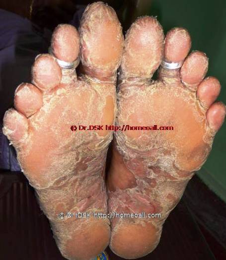 Psoriasis Homeopathy Specialty treatment Dr.Senthil Kumar, Vivekanantha homeopathy clinic, Velachery, Chennai, Panruti, pondichery, Cuddalore (14) Psoriasis - சொரியாசிஸ் சொரியாசிஸ் - Psoriasis என்றால் என்ன ? சொரியாசிஸ் என்பது தோல் அழற்சி நிலையாகும். இதை மீன் செதில் படை என்றும் அழைக்கலாம். சொரியாசிஸ் தோலில் உள்ள செல்கள் வேகமாக இறப்பதன் மூலம் உண்டாகிறது. இதன் விளைவாக தோல் தடித்து மீன் செதில் போன்று இறந்த செல்கள் உதிரும், புரையோடும். தோலிலுள்ள பல சிறு இரத்த நாளங்கள் வீங்கிவிடுவதால் தோல் சிவப்பு நிறமாகக் காணப்படும். சொரியாசிஸ் எவ்வாறு தோற்றமளிக்கும்? • சொரியாசிஸ் என்பது தோலில், மீன் செதில் போன்று இறந்த செல்கள் உதிர்ந்து விழும் புரையுடன் கூடிய வெண்மை / சிவப்பு திட்டுகளாக (Silver Scaly patches) காணப்படும். • உடலின் எந்தப்பாகத்தில் வேண்டுமானாலும் வரலாம். • முழங்கை, முழுங்கால் மூட்டு, முதுகு, தலையுச்சி முதலிய பாகங்கள் பொதுவாக பாதிக்கப்படும். சொரியாசிஸ் தொற்று நோயா? • சொரியாசிஸ் தொற்று நோயல்ல. இது மற்றவர்களுக்கு பரவாது • சுகாதார குறைவு காரணமாக இது ஏற்படாது. சொரியாசிஸ் வர காரணம் என்ன ? • சொரியாசிஸ் மரபு காரணம் மற்றும் சுற்றுச் சூழல் நிலை இவற்றின் பாதிப்பினால் ஏற்படுகிறது என்று நம்பப்படுகிறது. • சொரியாசிஸால் பாதிக்கப்படுபவர்களில் 25% பேர் சொரியாசிஸ் நோயுடைய குடும்பத்திலிருந்து வந்தவர்களே, சிலருக்கு மரபு நிலை காரணமாகிறது. • உடல், மன அழுத்தங்கள், குரல்வளை தொற்று, ப்ளூ, ஸ்டீராய்ட் ஹார்மோன்ஸ், சில ஆண்ட்டி ஹைபர் டென்சிவ் போன்ற சில மருந்துகள், சோரியாசிஸை மேலும் மோசமாக்கும். • குடிபழக்கம், புகைபிடித்தல் சொரியாசிஸை மோசமாக்கும். சொரியாசிஸ் நோயின் விளைவுகள் • சொரியாசிஸ் நோயாளிகளுக்கு மூட்டுவலிகளும், வீக்கமும் வரலாம். • சொரியாசிஸ் விரல்களையும், கால்விரல் நகங்களையும் தாக்கி, சிறு குழிகளையும், கருமை நிறத்தையும், நகங்கள் தடிப்பையும், ஏற்படுத்தும். நகம் உடையலாம். சொரியாசிஸ் யாருக்கு வரும் ? • சொரியாசிஸ் ஆண், பெண் இருவரையும் சமமாகத் தாக்கலாம். • சொரியாசிஸ் எந்த வயதில் வேண்டுமானாலும் வரலாம். வழக்கமாக 20 வது வயதில் தாக்கத் தொடங்கும். பிறப்பிலிருந்தும் முதிய வயதிலும் கூட இது வரலாம். • ஒரு முறை சொரியாசிஸ் வந்ததும், குறைதல், தணிதல், அதிகரித்தல் என பல்வேறு நிலை மாற்றங்கள் ஏற்படும். சொரியாசிஸ்க்கு என்ன மருத்துவங்கள் உள்ளன. நவீன மருத்துவத்தில் பல மருந்துகள் உபயோகப்படுத்தப்படுகின்றன, டாபிகல் ஸ்டீராய்ட்ஸ் மேற்பூச்சுக்கள் (Steroids creams), போட்டோதெரபி, அல்ட்ரா வைலட், மெதாட்டுரக்ஸாட் (methotrexate) இத்தகைய மருந்துகள் பக்க விளைவுகளை ஏற்படுத்தும். எனவே நோயாளிகள் இந்தப் பக்க விளைவுகளைப் பரிசோதித்துக் கொள்ள அடிக்கடி இரத்த பரிசோதனை செய்து கொள்ள வேண்டும். மேலும் தொடர்ந்து இந்த மருந்துகளை உட்கொள்ளக்கூடாது. சொரியாசிஸ் நோயாளிகள் செய்யக்கூடாதவை, செய்ய வேண்டியவை  தோலைச் சொரியாதீர்கள் ஏனெனில் இது குணமாவதைத் தாமதப்படுத்தும்.  ஹோமியோபதி மருந்துகள் வேலை செய்து விளைவுகள் காட்ட பல வாரங்கள் ஆகுமாதலால் மருத்துவத்தை விரைவில், இடையில் நிறுத்திவிடாதீர்கள்.  சொரியாசிஸைக் கட்டுப்படுத்த தரப்பட்ட மருந்துகளையும், மருத்துவத்தையும் திடீரென்று நிறுத்திவிடாதீர்கள். இதனால் நோய் இன்னும் மோசமாகும்.  மருந்துகளை தொடர்ந்து சீராக எடுத்துக்கொள்ளுங்கள்.  தோலை எப்போதும் ஈரத்தன்மையுடையதாக வைத்திருங்கள். அது நமைச்சலையும், அரிப்பையும், புரை ஏற்படுவதையும் தடுக்கும்.  சூரிய ஒளியில் இருப்பது பொதுவாக நல்லதே, ஆனால் அதிகமாக வெகு நேரம் இருப்பதால் வேர்க்குருக்கள் உண்டாகும். அதனால் சொரியாசிஸ் தீவிரமடையும்.  மன அழுத்தம் சொரியாசிஸை அதிகப்படுத்தும். அமைதியாக இருக்கவும், உடற்பயிற்சி செய்யவும், ஒய்வு எடுத்துக்கொள்ளவும், சோரியாஸிஸ் ஹோமியோபதி மருத்துவ சிகிச்சை, நோயின் அறிகுறிகளுக்கேற்ற ஹோமியோபதி மருத்துவசிகிச்சை நோயின் தன்மையை நன்கு கட்டுப்படுத்தி விரைவில் நல்ல பலனளிக்கும். தொடர்ந்து ஹோமியோபதி மருந்துகளை உட்கொள்வதன் மூலம் நல்ல பலன்பெறலாம். ஹோமியோபதி சிகிச்சைக்கு தொடர்பு கொள்ளவும் ஹோமியோபதி சிறப்பு மருத்துவர் செந்தில் குமார் தண்டபாணி அவர்களிடம் இதைப்போன்ற நோய்களுக்கு சிகிச்சை பெற்று பலர் நல்ல பலனடைந்திருக்கிறார்கள். மருத்துவர் செந்தில் குமார் அவர்களை சென்னை, வேளச்சேரி விவேகானந்தா ஹோமியோபதி கிளினிக் & உளவியல் ஆலோசனை மையத்தில் சந்திக்கலாம். முன்பதிவு அவசியம். முன்பதிவிற்கு தொடர்புகொள்ளவும் 9786901830, மின் அஞ்சல்: consult.ur.dr@gmail.com மேலும் விபரங்களுக்கும் ஆலோசனைக்கும் சிகிச்சைக்கும் தொடர்பு கொள்க விவேகானந்தா கிளினிக் ஆலோசனை மையங்கள் & தொடர்பு எண்கள் சென்னை:- 9786901830 பண்ருட்டி:- 9443054168 புதுச்சேரி:- 9865212055 (Camp) மின் அஞ்சல் : consult.ur.dr@gmail.com, homoeokumar@gmail.com முன்பதிவிற்கு அழைக்கவும் அல்லது மின் அஞ்சல் அனுப்பவும். முன்பதிவிற்கு: உங்களின் பெயர் - வயது – அலைபேசி எண் – பிரச்சனை (ஒரு வரியில்) தேதி – கிழமை – இடம், முதலியவற்றை குறுந்தகவல் மூலம் அனுப்பவும். உதாரணம்: ரம்யா - 28 – 99******00 – சோரியாசிஸ் Psoriasis – 20-12-2014 – சனிக்கிழமை – சென்னை, மருத்துவர் உங்களின் முன்பதிவை குறுந்தகவல் மூலம் உறுதிப்படுத்துவார்.