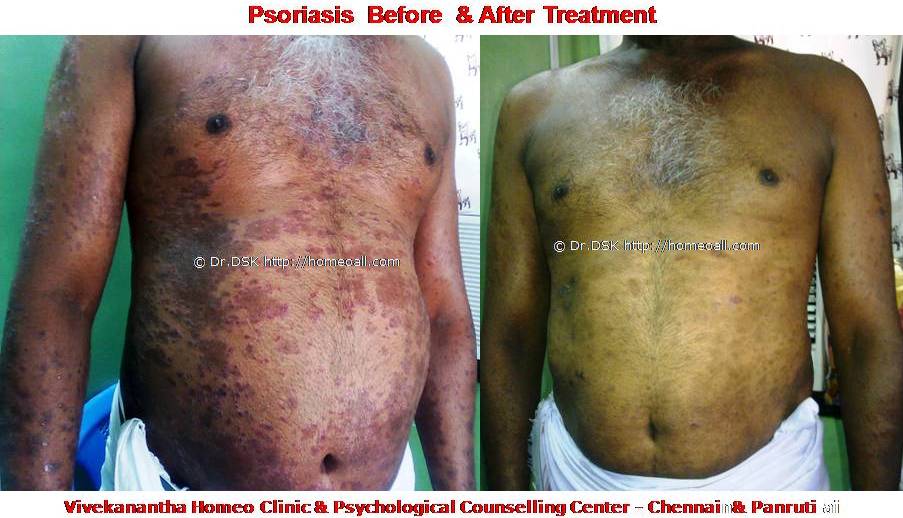 Psoriasis Homeopathy Specialty treatment Dr.Senthil Kumar, Vivekanantha homeopathy clinic, Velachery, Chennai, Panruti, pondichery, Cuddalore (3) Psoriasis - சொரியாசிஸ் சொரியாசிஸ் - Psoriasis என்றால் என்ன ? சொரியாசிஸ் என்பது தோல் அழற்சி நிலையாகும். இதை மீன் செதில் படை என்றும் அழைக்கலாம். சொரியாசிஸ் தோலில் உள்ள செல்கள் வேகமாக இறப்பதன் மூலம் உண்டாகிறது. இதன் விளைவாக தோல் தடித்து மீன் செதில் போன்று இறந்த செல்கள் உதிரும், புரையோடும். தோலிலுள்ள பல சிறு இரத்த நாளங்கள் வீங்கிவிடுவதால் தோல் சிவப்பு நிறமாகக் காணப்படும். சொரியாசிஸ் எவ்வாறு தோற்றமளிக்கும்? • சொரியாசிஸ் என்பது தோலில், மீன் செதில் போன்று இறந்த செல்கள் உதிர்ந்து விழும் புரையுடன் கூடிய வெண்மை / சிவப்பு திட்டுகளாக (Silver Scaly patches) காணப்படும். • உடலின் எந்தப்பாகத்தில் வேண்டுமானாலும் வரலாம். • முழங்கை, முழுங்கால் மூட்டு, முதுகு, தலையுச்சி முதலிய பாகங்கள் பொதுவாக பாதிக்கப்படும். சொரியாசிஸ் தொற்று நோயா? • சொரியாசிஸ் தொற்று நோயல்ல. இது மற்றவர்களுக்கு பரவாது • சுகாதார குறைவு காரணமாக இது ஏற்படாது. சொரியாசிஸ் வர காரணம் என்ன ? • சொரியாசிஸ் மரபு காரணம் மற்றும் சுற்றுச் சூழல் நிலை இவற்றின் பாதிப்பினால் ஏற்படுகிறது என்று நம்பப்படுகிறது. • சொரியாசிஸால் பாதிக்கப்படுபவர்களில் 25% பேர் சொரியாசிஸ் நோயுடைய குடும்பத்திலிருந்து வந்தவர்களே, சிலருக்கு மரபு நிலை காரணமாகிறது. • உடல், மன அழுத்தங்கள், குரல்வளை தொற்று, ப்ளூ, ஸ்டீராய்ட் ஹார்மோன்ஸ், சில ஆண்ட்டி ஹைபர் டென்சிவ் போன்ற சில மருந்துகள், சோரியாசிஸை மேலும் மோசமாக்கும். • குடிபழக்கம், புகைபிடித்தல் சொரியாசிஸை மோசமாக்கும். சொரியாசிஸ் நோயின் விளைவுகள் • சொரியாசிஸ் நோயாளிகளுக்கு மூட்டுவலிகளும், வீக்கமும் வரலாம். • சொரியாசிஸ் விரல்களையும், கால்விரல் நகங்களையும் தாக்கி, சிறு குழிகளையும், கருமை நிறத்தையும், நகங்கள் தடிப்பையும், ஏற்படுத்தும். நகம் உடையலாம். சொரியாசிஸ் யாருக்கு வரும் ? • சொரியாசிஸ் ஆண், பெண் இருவரையும் சமமாகத் தாக்கலாம். • சொரியாசிஸ் எந்த வயதில் வேண்டுமானாலும் வரலாம். வழக்கமாக 20 வது வயதில் தாக்கத் தொடங்கும். பிறப்பிலிருந்தும் முதிய வயதிலும் கூட இது வரலாம். • ஒரு முறை சொரியாசிஸ் வந்ததும், குறைதல், தணிதல், அதிகரித்தல் என பல்வேறு நிலை மாற்றங்கள் ஏற்படும். சொரியாசிஸ்க்கு என்ன மருத்துவங்கள் உள்ளன. நவீன மருத்துவத்தில் பல மருந்துகள் உபயோகப்படுத்தப்படுகின்றன, டாபிகல் ஸ்டீராய்ட்ஸ் மேற்பூச்சுக்கள் (Steroids creams), போட்டோதெரபி, அல்ட்ரா வைலட், மெதாட்டுரக்ஸாட் (methotrexate) இத்தகைய மருந்துகள் பக்க விளைவுகளை ஏற்படுத்தும். எனவே நோயாளிகள் இந்தப் பக்க விளைவுகளைப் பரிசோதித்துக் கொள்ள அடிக்கடி இரத்த பரிசோதனை செய்து கொள்ள வேண்டும். மேலும் தொடர்ந்து இந்த மருந்துகளை உட்கொள்ளக்கூடாது. சொரியாசிஸ் நோயாளிகள் செய்யக்கூடாதவை, செய்ய வேண்டியவை  தோலைச் சொரியாதீர்கள் ஏனெனில் இது குணமாவதைத் தாமதப்படுத்தும்.  ஹோமியோபதி மருந்துகள் வேலை செய்து விளைவுகள் காட்ட பல வாரங்கள் ஆகுமாதலால் மருத்துவத்தை விரைவில், இடையில் நிறுத்திவிடாதீர்கள்.  சொரியாசிஸைக் கட்டுப்படுத்த தரப்பட்ட மருந்துகளையும், மருத்துவத்தையும் திடீரென்று நிறுத்திவிடாதீர்கள். இதனால் நோய் இன்னும் மோசமாகும்.  மருந்துகளை தொடர்ந்து சீராக எடுத்துக்கொள்ளுங்கள்.  தோலை எப்போதும் ஈரத்தன்மையுடையதாக வைத்திருங்கள். அது நமைச்சலையும், அரிப்பையும், புரை ஏற்படுவதையும் தடுக்கும்.  சூரிய ஒளியில் இருப்பது பொதுவாக நல்லதே, ஆனால் அதிகமாக வெகு நேரம் இருப்பதால் வேர்க்குருக்கள் உண்டாகும். அதனால் சொரியாசிஸ் தீவிரமடையும்.  மன அழுத்தம் சொரியாசிஸை அதிகப்படுத்தும். அமைதியாக இருக்கவும், உடற்பயிற்சி செய்யவும், ஒய்வு எடுத்துக்கொள்ளவும், சோரியாஸிஸ் ஹோமியோபதி மருத்துவ சிகிச்சை, நோயின் அறிகுறிகளுக்கேற்ற ஹோமியோபதி மருத்துவசிகிச்சை நோயின் தன்மையை நன்கு கட்டுப்படுத்தி விரைவில் நல்ல பலனளிக்கும். தொடர்ந்து ஹோமியோபதி மருந்துகளை உட்கொள்வதன் மூலம் நல்ல பலன்பெறலாம். ஹோமியோபதி சிகிச்சைக்கு தொடர்பு கொள்ளவும் ஹோமியோபதி சிறப்பு மருத்துவர் செந்தில் குமார் தண்டபாணி அவர்களிடம் இதைப்போன்ற நோய்களுக்கு சிகிச்சை பெற்று பலர் நல்ல பலனடைந்திருக்கிறார்கள். மருத்துவர் செந்தில் குமார் அவர்களை சென்னை, வேளச்சேரி விவேகானந்தா ஹோமியோபதி கிளினிக் & உளவியல் ஆலோசனை மையத்தில் சந்திக்கலாம். முன்பதிவு அவசியம். முன்பதிவிற்கு தொடர்புகொள்ளவும் 9786901830, மின் அஞ்சல்: consult.ur.dr@gmail.com மேலும் விபரங்களுக்கும் ஆலோசனைக்கும் சிகிச்சைக்கும் தொடர்பு கொள்க விவேகானந்தா கிளினிக் ஆலோசனை மையங்கள் & தொடர்பு எண்கள் சென்னை:- 9786901830 பண்ருட்டி:- 9443054168 புதுச்சேரி:- 9865212055 (Camp) மின் அஞ்சல் : consult.ur.dr@gmail.com, homoeokumar@gmail.com முன்பதிவிற்கு அழைக்கவும் அல்லது மின் அஞ்சல் அனுப்பவும். முன்பதிவிற்கு: உங்களின் பெயர் - வயது – அலைபேசி எண் – பிரச்சனை (ஒரு வரியில்) தேதி – கிழமை – இடம், முதலியவற்றை குறுந்தகவல் மூலம் அனுப்பவும். உதாரணம்: ரம்யா - 28 – 99******00 – சோரியாசிஸ் Psoriasis – 20-12-2014 – சனிக்கிழமை – சென்னை, மருத்துவர் உங்களின் முன்பதிவை குறுந்தகவல் மூலம் உறுதிப்படுத்துவார்.