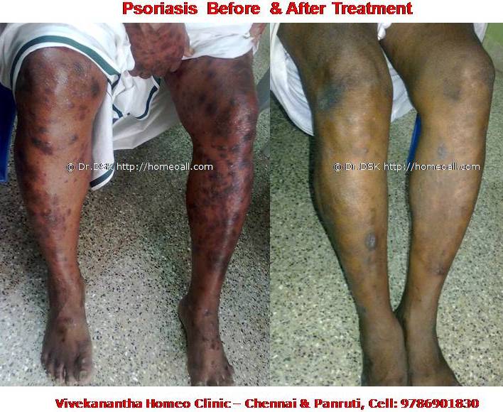 Psoriasis Homeopathy Specialty treatment Dr.Senthil Kumar, Vivekanantha homeopathy clinic, Velachery, Chennai, Panruti, pondichery, Cuddalore (4) Psoriasis - சொரியாசிஸ் சொரியாசிஸ் - Psoriasis என்றால் என்ன ? சொரியாசிஸ் என்பது தோல் அழற்சி நிலையாகும். இதை மீன் செதில் படை என்றும் அழைக்கலாம். சொரியாசிஸ் தோலில் உள்ள செல்கள் வேகமாக இறப்பதன் மூலம் உண்டாகிறது. இதன் விளைவாக தோல் தடித்து மீன் செதில் போன்று இறந்த செல்கள் உதிரும், புரையோடும். தோலிலுள்ள பல சிறு இரத்த நாளங்கள் வீங்கிவிடுவதால் தோல் சிவப்பு நிறமாகக் காணப்படும். சொரியாசிஸ் எவ்வாறு தோற்றமளிக்கும்? • சொரியாசிஸ் என்பது தோலில், மீன் செதில் போன்று இறந்த செல்கள் உதிர்ந்து விழும் புரையுடன் கூடிய வெண்மை / சிவப்பு திட்டுகளாக (Silver Scaly patches) காணப்படும். • உடலின் எந்தப்பாகத்தில் வேண்டுமானாலும் வரலாம். • முழங்கை, முழுங்கால் மூட்டு, முதுகு, தலையுச்சி முதலிய பாகங்கள் பொதுவாக பாதிக்கப்படும். சொரியாசிஸ் தொற்று நோயா? • சொரியாசிஸ் தொற்று நோயல்ல. இது மற்றவர்களுக்கு பரவாது • சுகாதார குறைவு காரணமாக இது ஏற்படாது. சொரியாசிஸ் வர காரணம் என்ன ? • சொரியாசிஸ் மரபு காரணம் மற்றும் சுற்றுச் சூழல் நிலை இவற்றின் பாதிப்பினால் ஏற்படுகிறது என்று நம்பப்படுகிறது. • சொரியாசிஸால் பாதிக்கப்படுபவர்களில் 25% பேர் சொரியாசிஸ் நோயுடைய குடும்பத்திலிருந்து வந்தவர்களே, சிலருக்கு மரபு நிலை காரணமாகிறது. • உடல், மன அழுத்தங்கள், குரல்வளை தொற்று, ப்ளூ, ஸ்டீராய்ட் ஹார்மோன்ஸ், சில ஆண்ட்டி ஹைபர் டென்சிவ் போன்ற சில மருந்துகள், சோரியாசிஸை மேலும் மோசமாக்கும். • குடிபழக்கம், புகைபிடித்தல் சொரியாசிஸை மோசமாக்கும். சொரியாசிஸ் நோயின் விளைவுகள் • சொரியாசிஸ் நோயாளிகளுக்கு மூட்டுவலிகளும், வீக்கமும் வரலாம். • சொரியாசிஸ் விரல்களையும், கால்விரல் நகங்களையும் தாக்கி, சிறு குழிகளையும், கருமை நிறத்தையும், நகங்கள் தடிப்பையும், ஏற்படுத்தும். நகம் உடையலாம். சொரியாசிஸ் யாருக்கு வரும் ? • சொரியாசிஸ் ஆண், பெண் இருவரையும் சமமாகத் தாக்கலாம். • சொரியாசிஸ் எந்த வயதில் வேண்டுமானாலும் வரலாம். வழக்கமாக 20 வது வயதில் தாக்கத் தொடங்கும். பிறப்பிலிருந்தும் முதிய வயதிலும் கூட இது வரலாம். • ஒரு முறை சொரியாசிஸ் வந்ததும், குறைதல், தணிதல், அதிகரித்தல் என பல்வேறு நிலை மாற்றங்கள் ஏற்படும். சொரியாசிஸ்க்கு என்ன மருத்துவங்கள் உள்ளன. நவீன மருத்துவத்தில் பல மருந்துகள் உபயோகப்படுத்தப்படுகின்றன, டாபிகல் ஸ்டீராய்ட்ஸ் மேற்பூச்சுக்கள் (Steroids creams), போட்டோதெரபி, அல்ட்ரா வைலட், மெதாட்டுரக்ஸாட் (methotrexate) இத்தகைய மருந்துகள் பக்க விளைவுகளை ஏற்படுத்தும். எனவே நோயாளிகள் இந்தப் பக்க விளைவுகளைப் பரிசோதித்துக் கொள்ள அடிக்கடி இரத்த பரிசோதனை செய்து கொள்ள வேண்டும். மேலும் தொடர்ந்து இந்த மருந்துகளை உட்கொள்ளக்கூடாது. சொரியாசிஸ் நோயாளிகள் செய்யக்கூடாதவை, செய்ய வேண்டியவை  தோலைச் சொரியாதீர்கள் ஏனெனில் இது குணமாவதைத் தாமதப்படுத்தும்.  ஹோமியோபதி மருந்துகள் வேலை செய்து விளைவுகள் காட்ட பல வாரங்கள் ஆகுமாதலால் மருத்துவத்தை விரைவில், இடையில் நிறுத்திவிடாதீர்கள்.  சொரியாசிஸைக் கட்டுப்படுத்த தரப்பட்ட மருந்துகளையும், மருத்துவத்தையும் திடீரென்று நிறுத்திவிடாதீர்கள். இதனால் நோய் இன்னும் மோசமாகும்.  மருந்துகளை தொடர்ந்து சீராக எடுத்துக்கொள்ளுங்கள்.  தோலை எப்போதும் ஈரத்தன்மையுடையதாக வைத்திருங்கள். அது நமைச்சலையும், அரிப்பையும், புரை ஏற்படுவதையும் தடுக்கும்.  சூரிய ஒளியில் இருப்பது பொதுவாக நல்லதே, ஆனால் அதிகமாக வெகு நேரம் இருப்பதால் வேர்க்குருக்கள் உண்டாகும். அதனால் சொரியாசிஸ் தீவிரமடையும்.  மன அழுத்தம் சொரியாசிஸை அதிகப்படுத்தும். அமைதியாக இருக்கவும், உடற்பயிற்சி செய்யவும், ஒய்வு எடுத்துக்கொள்ளவும், சோரியாஸிஸ் ஹோமியோபதி மருத்துவ சிகிச்சை, நோயின் அறிகுறிகளுக்கேற்ற ஹோமியோபதி மருத்துவசிகிச்சை நோயின் தன்மையை நன்கு கட்டுப்படுத்தி விரைவில் நல்ல பலனளிக்கும். தொடர்ந்து ஹோமியோபதி மருந்துகளை உட்கொள்வதன் மூலம் நல்ல பலன்பெறலாம். ஹோமியோபதி சிகிச்சைக்கு தொடர்பு கொள்ளவும் ஹோமியோபதி சிறப்பு மருத்துவர் செந்தில் குமார் தண்டபாணி அவர்களிடம் இதைப்போன்ற நோய்களுக்கு சிகிச்சை பெற்று பலர் நல்ல பலனடைந்திருக்கிறார்கள். மருத்துவர் செந்தில் குமார் அவர்களை சென்னை, வேளச்சேரி விவேகானந்தா ஹோமியோபதி கிளினிக் & உளவியல் ஆலோசனை மையத்தில் சந்திக்கலாம். முன்பதிவு அவசியம். முன்பதிவிற்கு தொடர்புகொள்ளவும் 9786901830, மின் அஞ்சல்: consult.ur.dr@gmail.com மேலும் விபரங்களுக்கும் ஆலோசனைக்கும் சிகிச்சைக்கும் தொடர்பு கொள்க விவேகானந்தா கிளினிக் ஆலோசனை மையங்கள் & தொடர்பு எண்கள் சென்னை:- 9786901830 பண்ருட்டி:- 9443054168 புதுச்சேரி:- 9865212055 (Camp) மின் அஞ்சல் : consult.ur.dr@gmail.com, homoeokumar@gmail.com முன்பதிவிற்கு அழைக்கவும் அல்லது மின் அஞ்சல் அனுப்பவும். முன்பதிவிற்கு: உங்களின் பெயர் - வயது – அலைபேசி எண் – பிரச்சனை (ஒரு வரியில்) தேதி – கிழமை – இடம், முதலியவற்றை குறுந்தகவல் மூலம் அனுப்பவும். உதாரணம்: ரம்யா - 28 – 99******00 – சோரியாசிஸ் Psoriasis – 20-12-2014 – சனிக்கிழமை – சென்னை, மருத்துவர் உங்களின் முன்பதிவை குறுந்தகவல் மூலம் உறுதிப்படுத்துவார்.
