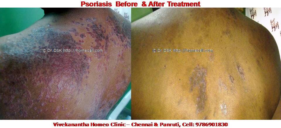 Psoriasis Homeopathy Specialty treatment Dr.Senthil Kumar, Vivekanantha homeopathy clinic, Velachery, Chennai, Panruti, pondichery, Cuddalore (5) Psoriasis - சொரியாசிஸ் சொரியாசிஸ் - Psoriasis என்றால் என்ன ? சொரியாசிஸ் என்பது தோல் அழற்சி நிலையாகும். இதை மீன் செதில் படை என்றும் அழைக்கலாம். சொரியாசிஸ் தோலில் உள்ள செல்கள் வேகமாக இறப்பதன் மூலம் உண்டாகிறது. இதன் விளைவாக தோல் தடித்து மீன் செதில் போன்று இறந்த செல்கள் உதிரும், புரையோடும். தோலிலுள்ள பல சிறு இரத்த நாளங்கள் வீங்கிவிடுவதால் தோல் சிவப்பு நிறமாகக் காணப்படும். சொரியாசிஸ் எவ்வாறு தோற்றமளிக்கும்? • சொரியாசிஸ் என்பது தோலில், மீன் செதில் போன்று இறந்த செல்கள் உதிர்ந்து விழும் புரையுடன் கூடிய வெண்மை / சிவப்பு திட்டுகளாக (Silver Scaly patches) காணப்படும். • உடலின் எந்தப்பாகத்தில் வேண்டுமானாலும் வரலாம். • முழங்கை, முழுங்கால் மூட்டு, முதுகு, தலையுச்சி முதலிய பாகங்கள் பொதுவாக பாதிக்கப்படும். சொரியாசிஸ் தொற்று நோயா? • சொரியாசிஸ் தொற்று நோயல்ல. இது மற்றவர்களுக்கு பரவாது • சுகாதார குறைவு காரணமாக இது ஏற்படாது. சொரியாசிஸ் வர காரணம் என்ன ? • சொரியாசிஸ் மரபு காரணம் மற்றும் சுற்றுச் சூழல் நிலை இவற்றின் பாதிப்பினால் ஏற்படுகிறது என்று நம்பப்படுகிறது. • சொரியாசிஸால் பாதிக்கப்படுபவர்களில் 25% பேர் சொரியாசிஸ் நோயுடைய குடும்பத்திலிருந்து வந்தவர்களே, சிலருக்கு மரபு நிலை காரணமாகிறது. • உடல், மன அழுத்தங்கள், குரல்வளை தொற்று, ப்ளூ, ஸ்டீராய்ட் ஹார்மோன்ஸ், சில ஆண்ட்டி ஹைபர் டென்சிவ் போன்ற சில மருந்துகள், சோரியாசிஸை மேலும் மோசமாக்கும். • குடிபழக்கம், புகைபிடித்தல் சொரியாசிஸை மோசமாக்கும். சொரியாசிஸ் நோயின் விளைவுகள் • சொரியாசிஸ் நோயாளிகளுக்கு மூட்டுவலிகளும், வீக்கமும் வரலாம். • சொரியாசிஸ் விரல்களையும், கால்விரல் நகங்களையும் தாக்கி, சிறு குழிகளையும், கருமை நிறத்தையும், நகங்கள் தடிப்பையும், ஏற்படுத்தும். நகம் உடையலாம். சொரியாசிஸ் யாருக்கு வரும் ? • சொரியாசிஸ் ஆண், பெண் இருவரையும் சமமாகத் தாக்கலாம். • சொரியாசிஸ் எந்த வயதில் வேண்டுமானாலும் வரலாம். வழக்கமாக 20 வது வயதில் தாக்கத் தொடங்கும். பிறப்பிலிருந்தும் முதிய வயதிலும் கூட இது வரலாம். • ஒரு முறை சொரியாசிஸ் வந்ததும், குறைதல், தணிதல், அதிகரித்தல் என பல்வேறு நிலை மாற்றங்கள் ஏற்படும். சொரியாசிஸ்க்கு என்ன மருத்துவங்கள் உள்ளன. நவீன மருத்துவத்தில் பல மருந்துகள் உபயோகப்படுத்தப்படுகின்றன, டாபிகல் ஸ்டீராய்ட்ஸ் மேற்பூச்சுக்கள் (Steroids creams), போட்டோதெரபி, அல்ட்ரா வைலட், மெதாட்டுரக்ஸாட் (methotrexate) இத்தகைய மருந்துகள் பக்க விளைவுகளை ஏற்படுத்தும். எனவே நோயாளிகள் இந்தப் பக்க விளைவுகளைப் பரிசோதித்துக் கொள்ள அடிக்கடி இரத்த பரிசோதனை செய்து கொள்ள வேண்டும். மேலும் தொடர்ந்து இந்த மருந்துகளை உட்கொள்ளக்கூடாது. சொரியாசிஸ் நோயாளிகள் செய்யக்கூடாதவை, செய்ய வேண்டியவை  தோலைச் சொரியாதீர்கள் ஏனெனில் இது குணமாவதைத் தாமதப்படுத்தும்.  ஹோமியோபதி மருந்துகள் வேலை செய்து விளைவுகள் காட்ட பல வாரங்கள் ஆகுமாதலால் மருத்துவத்தை விரைவில், இடையில் நிறுத்திவிடாதீர்கள்.  சொரியாசிஸைக் கட்டுப்படுத்த தரப்பட்ட மருந்துகளையும், மருத்துவத்தையும் திடீரென்று நிறுத்திவிடாதீர்கள். இதனால் நோய் இன்னும் மோசமாகும்.  மருந்துகளை தொடர்ந்து சீராக எடுத்துக்கொள்ளுங்கள்.  தோலை எப்போதும் ஈரத்தன்மையுடையதாக வைத்திருங்கள். அது நமைச்சலையும், அரிப்பையும், புரை ஏற்படுவதையும் தடுக்கும்.  சூரிய ஒளியில் இருப்பது பொதுவாக நல்லதே, ஆனால் அதிகமாக வெகு நேரம் இருப்பதால் வேர்க்குருக்கள் உண்டாகும். அதனால் சொரியாசிஸ் தீவிரமடையும்.  மன அழுத்தம் சொரியாசிஸை அதிகப்படுத்தும். அமைதியாக இருக்கவும், உடற்பயிற்சி செய்யவும், ஒய்வு எடுத்துக்கொள்ளவும், சோரியாஸிஸ் ஹோமியோபதி மருத்துவ சிகிச்சை, நோயின் அறிகுறிகளுக்கேற்ற ஹோமியோபதி மருத்துவசிகிச்சை நோயின் தன்மையை நன்கு கட்டுப்படுத்தி விரைவில் நல்ல பலனளிக்கும். தொடர்ந்து ஹோமியோபதி மருந்துகளை உட்கொள்வதன் மூலம் நல்ல பலன்பெறலாம். ஹோமியோபதி சிகிச்சைக்கு தொடர்பு கொள்ளவும் ஹோமியோபதி சிறப்பு மருத்துவர் செந்தில் குமார் தண்டபாணி அவர்களிடம் இதைப்போன்ற நோய்களுக்கு சிகிச்சை பெற்று பலர் நல்ல பலனடைந்திருக்கிறார்கள். மருத்துவர் செந்தில் குமார் அவர்களை சென்னை, வேளச்சேரி விவேகானந்தா ஹோமியோபதி கிளினிக் & உளவியல் ஆலோசனை மையத்தில் சந்திக்கலாம். முன்பதிவு அவசியம். முன்பதிவிற்கு தொடர்புகொள்ளவும் 9786901830, மின் அஞ்சல்: consult.ur.dr@gmail.com மேலும் விபரங்களுக்கும் ஆலோசனைக்கும் சிகிச்சைக்கும் தொடர்பு கொள்க விவேகானந்தா கிளினிக் ஆலோசனை மையங்கள் & தொடர்பு எண்கள் சென்னை:- 9786901830 பண்ருட்டி:- 9443054168 புதுச்சேரி:- 9865212055 (Camp) மின் அஞ்சல் : consult.ur.dr@gmail.com, homoeokumar@gmail.com முன்பதிவிற்கு அழைக்கவும் அல்லது மின் அஞ்சல் அனுப்பவும். முன்பதிவிற்கு: உங்களின் பெயர் - வயது – அலைபேசி எண் – பிரச்சனை (ஒரு வரியில்) தேதி – கிழமை – இடம், முதலியவற்றை குறுந்தகவல் மூலம் அனுப்பவும். உதாரணம்: ரம்யா - 28 – 99******00 – சோரியாசிஸ் Psoriasis – 20-12-2014 – சனிக்கிழமை – சென்னை, மருத்துவர் உங்களின் முன்பதிவை குறுந்தகவல் மூலம் உறுதிப்படுத்துவார்.