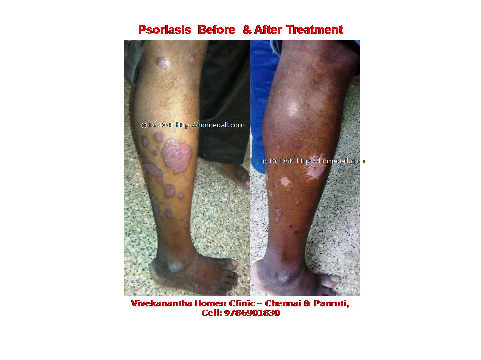 Psoriasis Homeopathy Specialty treatment Dr.Senthil Kumar, Vivekanantha homeopathy clinic, Velachery, Chennai, Panruti, pondichery, Cuddalore (7) Psoriasis - சொரியாசிஸ் சொரியாசிஸ் - Psoriasis என்றால் என்ன ? சொரியாசிஸ் என்பது தோல் அழற்சி நிலையாகும். இதை மீன் செதில் படை என்றும் அழைக்கலாம். சொரியாசிஸ் தோலில் உள்ள செல்கள் வேகமாக இறப்பதன் மூலம் உண்டாகிறது. இதன் விளைவாக தோல் தடித்து மீன் செதில் போன்று இறந்த செல்கள் உதிரும், புரையோடும். தோலிலுள்ள பல சிறு இரத்த நாளங்கள் வீங்கிவிடுவதால் தோல் சிவப்பு நிறமாகக் காணப்படும். சொரியாசிஸ் எவ்வாறு தோற்றமளிக்கும்? • சொரியாசிஸ் என்பது தோலில், மீன் செதில் போன்று இறந்த செல்கள் உதிர்ந்து விழும் புரையுடன் கூடிய வெண்மை / சிவப்பு திட்டுகளாக (Silver Scaly patches) காணப்படும். • உடலின் எந்தப்பாகத்தில் வேண்டுமானாலும் வரலாம். • முழங்கை, முழுங்கால் மூட்டு, முதுகு, தலையுச்சி முதலிய பாகங்கள் பொதுவாக பாதிக்கப்படும். சொரியாசிஸ் தொற்று நோயா? • சொரியாசிஸ் தொற்று நோயல்ல. இது மற்றவர்களுக்கு பரவாது • சுகாதார குறைவு காரணமாக இது ஏற்படாது. சொரியாசிஸ் வர காரணம் என்ன ? • சொரியாசிஸ் மரபு காரணம் மற்றும் சுற்றுச் சூழல் நிலை இவற்றின் பாதிப்பினால் ஏற்படுகிறது என்று நம்பப்படுகிறது. • சொரியாசிஸால் பாதிக்கப்படுபவர்களில் 25% பேர் சொரியாசிஸ் நோயுடைய குடும்பத்திலிருந்து வந்தவர்களே, சிலருக்கு மரபு நிலை காரணமாகிறது. • உடல், மன அழுத்தங்கள், குரல்வளை தொற்று, ப்ளூ, ஸ்டீராய்ட் ஹார்மோன்ஸ், சில ஆண்ட்டி ஹைபர் டென்சிவ் போன்ற சில மருந்துகள், சோரியாசிஸை மேலும் மோசமாக்கும். • குடிபழக்கம், புகைபிடித்தல் சொரியாசிஸை மோசமாக்கும். சொரியாசிஸ் நோயின் விளைவுகள் • சொரியாசிஸ் நோயாளிகளுக்கு மூட்டுவலிகளும், வீக்கமும் வரலாம். • சொரியாசிஸ் விரல்களையும், கால்விரல் நகங்களையும் தாக்கி, சிறு குழிகளையும், கருமை நிறத்தையும், நகங்கள் தடிப்பையும், ஏற்படுத்தும். நகம் உடையலாம். சொரியாசிஸ் யாருக்கு வரும் ? • சொரியாசிஸ் ஆண், பெண் இருவரையும் சமமாகத் தாக்கலாம். • சொரியாசிஸ் எந்த வயதில் வேண்டுமானாலும் வரலாம். வழக்கமாக 20 வது வயதில் தாக்கத் தொடங்கும். பிறப்பிலிருந்தும் முதிய வயதிலும் கூட இது வரலாம். • ஒரு முறை சொரியாசிஸ் வந்ததும், குறைதல், தணிதல், அதிகரித்தல் என பல்வேறு நிலை மாற்றங்கள் ஏற்படும். சொரியாசிஸ்க்கு என்ன மருத்துவங்கள் உள்ளன. நவீன மருத்துவத்தில் பல மருந்துகள் உபயோகப்படுத்தப்படுகின்றன, டாபிகல் ஸ்டீராய்ட்ஸ் மேற்பூச்சுக்கள் (Steroids creams), போட்டோதெரபி, அல்ட்ரா வைலட், மெதாட்டுரக்ஸாட் (methotrexate) இத்தகைய மருந்துகள் பக்க விளைவுகளை ஏற்படுத்தும். எனவே நோயாளிகள் இந்தப் பக்க விளைவுகளைப் பரிசோதித்துக் கொள்ள அடிக்கடி இரத்த பரிசோதனை செய்து கொள்ள வேண்டும். மேலும் தொடர்ந்து இந்த மருந்துகளை உட்கொள்ளக்கூடாது. சொரியாசிஸ் நோயாளிகள் செய்யக்கூடாதவை, செய்ய வேண்டியவை  தோலைச் சொரியாதீர்கள் ஏனெனில் இது குணமாவதைத் தாமதப்படுத்தும்.  ஹோமியோபதி மருந்துகள் வேலை செய்து விளைவுகள் காட்ட பல வாரங்கள் ஆகுமாதலால் மருத்துவத்தை விரைவில், இடையில் நிறுத்திவிடாதீர்கள்.  சொரியாசிஸைக் கட்டுப்படுத்த தரப்பட்ட மருந்துகளையும், மருத்துவத்தையும் திடீரென்று நிறுத்திவிடாதீர்கள். இதனால் நோய் இன்னும் மோசமாகும்.  மருந்துகளை தொடர்ந்து சீராக எடுத்துக்கொள்ளுங்கள்.  தோலை எப்போதும் ஈரத்தன்மையுடையதாக வைத்திருங்கள். அது நமைச்சலையும், அரிப்பையும், புரை ஏற்படுவதையும் தடுக்கும்.  சூரிய ஒளியில் இருப்பது பொதுவாக நல்லதே, ஆனால் அதிகமாக வெகு நேரம் இருப்பதால் வேர்க்குருக்கள் உண்டாகும். அதனால் சொரியாசிஸ் தீவிரமடையும்.  மன அழுத்தம் சொரியாசிஸை அதிகப்படுத்தும். அமைதியாக இருக்கவும், உடற்பயிற்சி செய்யவும், ஒய்வு எடுத்துக்கொள்ளவும், சோரியாஸிஸ் ஹோமியோபதி மருத்துவ சிகிச்சை, நோயின் அறிகுறிகளுக்கேற்ற ஹோமியோபதி மருத்துவசிகிச்சை நோயின் தன்மையை நன்கு கட்டுப்படுத்தி விரைவில் நல்ல பலனளிக்கும். தொடர்ந்து ஹோமியோபதி மருந்துகளை உட்கொள்வதன் மூலம் நல்ல பலன்பெறலாம். ஹோமியோபதி சிகிச்சைக்கு தொடர்பு கொள்ளவும் ஹோமியோபதி சிறப்பு மருத்துவர் செந்தில் குமார் தண்டபாணி அவர்களிடம் இதைப்போன்ற நோய்களுக்கு சிகிச்சை பெற்று பலர் நல்ல பலனடைந்திருக்கிறார்கள். மருத்துவர் செந்தில் குமார் அவர்களை சென்னை, வேளச்சேரி விவேகானந்தா ஹோமியோபதி கிளினிக் & உளவியல் ஆலோசனை மையத்தில் சந்திக்கலாம். முன்பதிவு அவசியம். முன்பதிவிற்கு தொடர்புகொள்ளவும் 9786901830, மின் அஞ்சல்: consult.ur.dr@gmail.com மேலும் விபரங்களுக்கும் ஆலோசனைக்கும் சிகிச்சைக்கும் தொடர்பு கொள்க விவேகானந்தா கிளினிக் ஆலோசனை மையங்கள் & தொடர்பு எண்கள் சென்னை:- 9786901830 பண்ருட்டி:- 9443054168 புதுச்சேரி:- 9865212055 (Camp) மின் அஞ்சல் : consult.ur.dr@gmail.com, homoeokumar@gmail.com முன்பதிவிற்கு அழைக்கவும் அல்லது மின் அஞ்சல் அனுப்பவும். முன்பதிவிற்கு: உங்களின் பெயர் - வயது – அலைபேசி எண் – பிரச்சனை (ஒரு வரியில்) தேதி – கிழமை – இடம், முதலியவற்றை குறுந்தகவல் மூலம் அனுப்பவும். உதாரணம்: ரம்யா - 28 – 99******00 – சோரியாசிஸ் Psoriasis – 20-12-2014 – சனிக்கிழமை – சென்னை, மருத்துவர் உங்களின் முன்பதிவை குறுந்தகவல் மூலம் உறுதிப்படுத்துவார்.