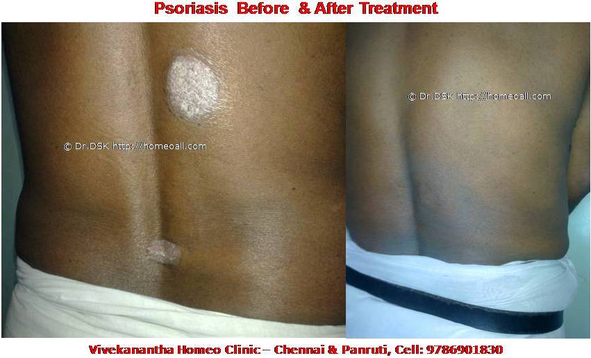Psoriasis Homeopathy Specialty treatment Dr.Senthil Kumar, Vivekanantha homeopathy clinic, Velachery, Chennai, Panruti, pondichery, Cuddalore (8) Psoriasis - சொரியாசிஸ் சொரியாசிஸ் - Psoriasis என்றால் என்ன ? சொரியாசிஸ் என்பது தோல் அழற்சி நிலையாகும். இதை மீன் செதில் படை என்றும் அழைக்கலாம். சொரியாசிஸ் தோலில் உள்ள செல்கள் வேகமாக இறப்பதன் மூலம் உண்டாகிறது. இதன் விளைவாக தோல் தடித்து மீன் செதில் போன்று இறந்த செல்கள் உதிரும், புரையோடும். தோலிலுள்ள பல சிறு இரத்த நாளங்கள் வீங்கிவிடுவதால் தோல் சிவப்பு நிறமாகக் காணப்படும். சொரியாசிஸ் எவ்வாறு தோற்றமளிக்கும்? • சொரியாசிஸ் என்பது தோலில், மீன் செதில் போன்று இறந்த செல்கள் உதிர்ந்து விழும் புரையுடன் கூடிய வெண்மை / சிவப்பு திட்டுகளாக (Silver Scaly patches) காணப்படும். • உடலின் எந்தப்பாகத்தில் வேண்டுமானாலும் வரலாம். • முழங்கை, முழுங்கால் மூட்டு, முதுகு, தலையுச்சி முதலிய பாகங்கள் பொதுவாக பாதிக்கப்படும். சொரியாசிஸ் தொற்று நோயா? • சொரியாசிஸ் தொற்று நோயல்ல. இது மற்றவர்களுக்கு பரவாது • சுகாதார குறைவு காரணமாக இது ஏற்படாது. சொரியாசிஸ் வர காரணம் என்ன ? • சொரியாசிஸ் மரபு காரணம் மற்றும் சுற்றுச் சூழல் நிலை இவற்றின் பாதிப்பினால் ஏற்படுகிறது என்று நம்பப்படுகிறது. • சொரியாசிஸால் பாதிக்கப்படுபவர்களில் 25% பேர் சொரியாசிஸ் நோயுடைய குடும்பத்திலிருந்து வந்தவர்களே, சிலருக்கு மரபு நிலை காரணமாகிறது. • உடல், மன அழுத்தங்கள், குரல்வளை தொற்று, ப்ளூ, ஸ்டீராய்ட் ஹார்மோன்ஸ், சில ஆண்ட்டி ஹைபர் டென்சிவ் போன்ற சில மருந்துகள், சோரியாசிஸை மேலும் மோசமாக்கும். • குடிபழக்கம், புகைபிடித்தல் சொரியாசிஸை மோசமாக்கும். சொரியாசிஸ் நோயின் விளைவுகள் • சொரியாசிஸ் நோயாளிகளுக்கு மூட்டுவலிகளும், வீக்கமும் வரலாம். • சொரியாசிஸ் விரல்களையும், கால்விரல் நகங்களையும் தாக்கி, சிறு குழிகளையும், கருமை நிறத்தையும், நகங்கள் தடிப்பையும், ஏற்படுத்தும். நகம் உடையலாம். சொரியாசிஸ் யாருக்கு வரும் ? • சொரியாசிஸ் ஆண், பெண் இருவரையும் சமமாகத் தாக்கலாம். • சொரியாசிஸ் எந்த வயதில் வேண்டுமானாலும் வரலாம். வழக்கமாக 20 வது வயதில் தாக்கத் தொடங்கும். பிறப்பிலிருந்தும் முதிய வயதிலும் கூட இது வரலாம். • ஒரு முறை சொரியாசிஸ் வந்ததும், குறைதல், தணிதல், அதிகரித்தல் என பல்வேறு நிலை மாற்றங்கள் ஏற்படும். சொரியாசிஸ்க்கு என்ன மருத்துவங்கள் உள்ளன. நவீன மருத்துவத்தில் பல மருந்துகள் உபயோகப்படுத்தப்படுகின்றன, டாபிகல் ஸ்டீராய்ட்ஸ் மேற்பூச்சுக்கள் (Steroids creams), போட்டோதெரபி, அல்ட்ரா வைலட், மெதாட்டுரக்ஸாட் (methotrexate) இத்தகைய மருந்துகள் பக்க விளைவுகளை ஏற்படுத்தும். எனவே நோயாளிகள் இந்தப் பக்க விளைவுகளைப் பரிசோதித்துக் கொள்ள அடிக்கடி இரத்த பரிசோதனை செய்து கொள்ள வேண்டும். மேலும் தொடர்ந்து இந்த மருந்துகளை உட்கொள்ளக்கூடாது. சொரியாசிஸ் நோயாளிகள் செய்யக்கூடாதவை, செய்ய வேண்டியவை  தோலைச் சொரியாதீர்கள் ஏனெனில் இது குணமாவதைத் தாமதப்படுத்தும்.  ஹோமியோபதி மருந்துகள் வேலை செய்து விளைவுகள் காட்ட பல வாரங்கள் ஆகுமாதலால் மருத்துவத்தை விரைவில், இடையில் நிறுத்திவிடாதீர்கள்.  சொரியாசிஸைக் கட்டுப்படுத்த தரப்பட்ட மருந்துகளையும், மருத்துவத்தையும் திடீரென்று நிறுத்திவிடாதீர்கள். இதனால் நோய் இன்னும் மோசமாகும்.  மருந்துகளை தொடர்ந்து சீராக எடுத்துக்கொள்ளுங்கள்.  தோலை எப்போதும் ஈரத்தன்மையுடையதாக வைத்திருங்கள். அது நமைச்சலையும், அரிப்பையும், புரை ஏற்படுவதையும் தடுக்கும்.  சூரிய ஒளியில் இருப்பது பொதுவாக நல்லதே, ஆனால் அதிகமாக வெகு நேரம் இருப்பதால் வேர்க்குருக்கள் உண்டாகும். அதனால் சொரியாசிஸ் தீவிரமடையும்.  மன அழுத்தம் சொரியாசிஸை அதிகப்படுத்தும். அமைதியாக இருக்கவும், உடற்பயிற்சி செய்யவும், ஒய்வு எடுத்துக்கொள்ளவும், சோரியாஸிஸ் ஹோமியோபதி மருத்துவ சிகிச்சை, நோயின் அறிகுறிகளுக்கேற்ற ஹோமியோபதி மருத்துவசிகிச்சை நோயின் தன்மையை நன்கு கட்டுப்படுத்தி விரைவில் நல்ல பலனளிக்கும். தொடர்ந்து ஹோமியோபதி மருந்துகளை உட்கொள்வதன் மூலம் நல்ல பலன்பெறலாம். ஹோமியோபதி சிகிச்சைக்கு தொடர்பு கொள்ளவும் ஹோமியோபதி சிறப்பு மருத்துவர் செந்தில் குமார் தண்டபாணி அவர்களிடம் இதைப்போன்ற நோய்களுக்கு சிகிச்சை பெற்று பலர் நல்ல பலனடைந்திருக்கிறார்கள். மருத்துவர் செந்தில் குமார் அவர்களை சென்னை, வேளச்சேரி விவேகானந்தா ஹோமியோபதி கிளினிக் & உளவியல் ஆலோசனை மையத்தில் சந்திக்கலாம். முன்பதிவு அவசியம். முன்பதிவிற்கு தொடர்புகொள்ளவும் 9786901830, மின் அஞ்சல்: consult.ur.dr@gmail.com மேலும் விபரங்களுக்கும் ஆலோசனைக்கும் சிகிச்சைக்கும் தொடர்பு கொள்க விவேகானந்தா கிளினிக் ஆலோசனை மையங்கள் & தொடர்பு எண்கள் சென்னை:- 9786901830 பண்ருட்டி:- 9443054168 புதுச்சேரி:- 9865212055 (Camp) மின் அஞ்சல் : consult.ur.dr@gmail.com, homoeokumar@gmail.com முன்பதிவிற்கு அழைக்கவும் அல்லது மின் அஞ்சல் அனுப்பவும். முன்பதிவிற்கு: உங்களின் பெயர் - வயது – அலைபேசி எண் – பிரச்சனை (ஒரு வரியில்) தேதி – கிழமை – இடம், முதலியவற்றை குறுந்தகவல் மூலம் அனுப்பவும். உதாரணம்: ரம்யா - 28 – 99******00 – சோரியாசிஸ் Psoriasis – 20-12-2014 – சனிக்கிழமை – சென்னை, மருத்துவர் உங்களின் முன்பதிவை குறுந்தகவல் மூலம் உறுதிப்படுத்துவார்.