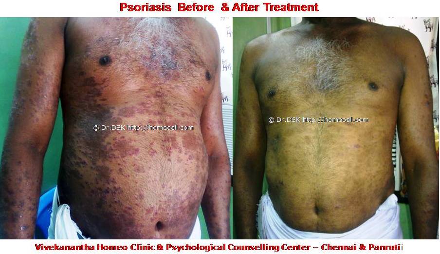Psoriasis Homeopathy Specialty treatment Dr.Senthil Kumar, Vivekanantha homeopathy clinic, Velachery, Chennai, Panruti, pondichery, Cuddalore (9) Psoriasis - சொரியாசிஸ் சொரியாசிஸ் - Psoriasis என்றால் என்ன ? சொரியாசிஸ் என்பது தோல் அழற்சி நிலையாகும். இதை மீன் செதில் படை என்றும் அழைக்கலாம். சொரியாசிஸ் தோலில் உள்ள செல்கள் வேகமாக இறப்பதன் மூலம் உண்டாகிறது. இதன் விளைவாக தோல் தடித்து மீன் செதில் போன்று இறந்த செல்கள் உதிரும், புரையோடும். தோலிலுள்ள பல சிறு இரத்த நாளங்கள் வீங்கிவிடுவதால் தோல் சிவப்பு நிறமாகக் காணப்படும். சொரியாசிஸ் எவ்வாறு தோற்றமளிக்கும்? • சொரியாசிஸ் என்பது தோலில், மீன் செதில் போன்று இறந்த செல்கள் உதிர்ந்து விழும் புரையுடன் கூடிய வெண்மை / சிவப்பு திட்டுகளாக (Silver Scaly patches) காணப்படும். • உடலின் எந்தப்பாகத்தில் வேண்டுமானாலும் வரலாம். • முழங்கை, முழுங்கால் மூட்டு, முதுகு, தலையுச்சி முதலிய பாகங்கள் பொதுவாக பாதிக்கப்படும். சொரியாசிஸ் தொற்று நோயா? • சொரியாசிஸ் தொற்று நோயல்ல. இது மற்றவர்களுக்கு பரவாது • சுகாதார குறைவு காரணமாக இது ஏற்படாது. சொரியாசிஸ் வர காரணம் என்ன ? • சொரியாசிஸ் மரபு காரணம் மற்றும் சுற்றுச் சூழல் நிலை இவற்றின் பாதிப்பினால் ஏற்படுகிறது என்று நம்பப்படுகிறது. • சொரியாசிஸால் பாதிக்கப்படுபவர்களில் 25% பேர் சொரியாசிஸ் நோயுடைய குடும்பத்திலிருந்து வந்தவர்களே, சிலருக்கு மரபு நிலை காரணமாகிறது. • உடல், மன அழுத்தங்கள், குரல்வளை தொற்று, ப்ளூ, ஸ்டீராய்ட் ஹார்மோன்ஸ், சில ஆண்ட்டி ஹைபர் டென்சிவ் போன்ற சில மருந்துகள், சோரியாசிஸை மேலும் மோசமாக்கும். • குடிபழக்கம், புகைபிடித்தல் சொரியாசிஸை மோசமாக்கும். சொரியாசிஸ் நோயின் விளைவுகள் • சொரியாசிஸ் நோயாளிகளுக்கு மூட்டுவலிகளும், வீக்கமும் வரலாம். • சொரியாசிஸ் விரல்களையும், கால்விரல் நகங்களையும் தாக்கி, சிறு குழிகளையும், கருமை நிறத்தையும், நகங்கள் தடிப்பையும், ஏற்படுத்தும். நகம் உடையலாம். சொரியாசிஸ் யாருக்கு வரும் ? • சொரியாசிஸ் ஆண், பெண் இருவரையும் சமமாகத் தாக்கலாம். • சொரியாசிஸ் எந்த வயதில் வேண்டுமானாலும் வரலாம். வழக்கமாக 20 வது வயதில் தாக்கத் தொடங்கும். பிறப்பிலிருந்தும் முதிய வயதிலும் கூட இது வரலாம். • ஒரு முறை சொரியாசிஸ் வந்ததும், குறைதல், தணிதல், அதிகரித்தல் என பல்வேறு நிலை மாற்றங்கள் ஏற்படும். சொரியாசிஸ்க்கு என்ன மருத்துவங்கள் உள்ளன. நவீன மருத்துவத்தில் பல மருந்துகள் உபயோகப்படுத்தப்படுகின்றன, டாபிகல் ஸ்டீராய்ட்ஸ் மேற்பூச்சுக்கள் (Steroids creams), போட்டோதெரபி, அல்ட்ரா வைலட், மெதாட்டுரக்ஸாட் (methotrexate) இத்தகைய மருந்துகள் பக்க விளைவுகளை ஏற்படுத்தும். எனவே நோயாளிகள் இந்தப் பக்க விளைவுகளைப் பரிசோதித்துக் கொள்ள அடிக்கடி இரத்த பரிசோதனை செய்து கொள்ள வேண்டும். மேலும் தொடர்ந்து இந்த மருந்துகளை உட்கொள்ளக்கூடாது. சொரியாசிஸ் நோயாளிகள் செய்யக்கூடாதவை, செய்ய வேண்டியவை  தோலைச் சொரியாதீர்கள் ஏனெனில் இது குணமாவதைத் தாமதப்படுத்தும்.  ஹோமியோபதி மருந்துகள் வேலை செய்து விளைவுகள் காட்ட பல வாரங்கள் ஆகுமாதலால் மருத்துவத்தை விரைவில், இடையில் நிறுத்திவிடாதீர்கள்.  சொரியாசிஸைக் கட்டுப்படுத்த தரப்பட்ட மருந்துகளையும், மருத்துவத்தையும் திடீரென்று நிறுத்திவிடாதீர்கள். இதனால் நோய் இன்னும் மோசமாகும்.  மருந்துகளை தொடர்ந்து சீராக எடுத்துக்கொள்ளுங்கள்.  தோலை எப்போதும் ஈரத்தன்மையுடையதாக வைத்திருங்கள். அது நமைச்சலையும், அரிப்பையும், புரை ஏற்படுவதையும் தடுக்கும்.  சூரிய ஒளியில் இருப்பது பொதுவாக நல்லதே, ஆனால் அதிகமாக வெகு நேரம் இருப்பதால் வேர்க்குருக்கள் உண்டாகும். அதனால் சொரியாசிஸ் தீவிரமடையும்.  மன அழுத்தம் சொரியாசிஸை அதிகப்படுத்தும். அமைதியாக இருக்கவும், உடற்பயிற்சி செய்யவும், ஒய்வு எடுத்துக்கொள்ளவும், சோரியாஸிஸ் ஹோமியோபதி மருத்துவ சிகிச்சை, நோயின் அறிகுறிகளுக்கேற்ற ஹோமியோபதி மருத்துவசிகிச்சை நோயின் தன்மையை நன்கு கட்டுப்படுத்தி விரைவில் நல்ல பலனளிக்கும். தொடர்ந்து ஹோமியோபதி மருந்துகளை உட்கொள்வதன் மூலம் நல்ல பலன்பெறலாம். ஹோமியோபதி சிகிச்சைக்கு தொடர்பு கொள்ளவும் ஹோமியோபதி சிறப்பு மருத்துவர் செந்தில் குமார் தண்டபாணி அவர்களிடம் இதைப்போன்ற நோய்களுக்கு சிகிச்சை பெற்று பலர் நல்ல பலனடைந்திருக்கிறார்கள். மருத்துவர் செந்தில் குமார் அவர்களை சென்னை, வேளச்சேரி விவேகானந்தா ஹோமியோபதி கிளினிக் & உளவியல் ஆலோசனை மையத்தில் சந்திக்கலாம். முன்பதிவு அவசியம். முன்பதிவிற்கு தொடர்புகொள்ளவும் 9786901830, மின் அஞ்சல்: consult.ur.dr@gmail.com மேலும் விபரங்களுக்கும் ஆலோசனைக்கும் சிகிச்சைக்கும் தொடர்பு கொள்க விவேகானந்தா கிளினிக் ஆலோசனை மையங்கள் & தொடர்பு எண்கள் சென்னை:- 9786901830 பண்ருட்டி:- 9443054168 புதுச்சேரி:- 9865212055 (Camp) மின் அஞ்சல் : consult.ur.dr@gmail.com, homoeokumar@gmail.com முன்பதிவிற்கு அழைக்கவும் அல்லது மின் அஞ்சல் அனுப்பவும். முன்பதிவிற்கு: உங்களின் பெயர் - வயது – அலைபேசி எண் – பிரச்சனை (ஒரு வரியில்) தேதி – கிழமை – இடம், முதலியவற்றை குறுந்தகவல் மூலம் அனுப்பவும். உதாரணம்: ரம்யா - 28 – 99******00 – சோரியாசிஸ் Psoriasis – 20-12-2014 – சனிக்கிழமை – சென்னை, மருத்துவர் உங்களின் முன்பதிவை குறுந்தகவல் மூலம் உறுதிப்படுத்துவார்.