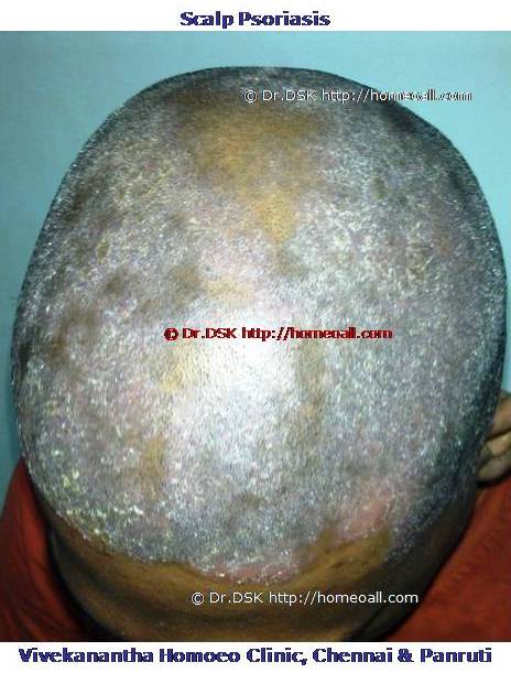 Scalp Psoriasis http://homeoall.com/psoriasis-homeopathy-treatment/ Psoriasis - சொரியாசிஸ் சொரியாசிஸ் - Psoriasis என்றால் என்ன ? சொரியாசிஸ் என்பது தோல் அழற்சி நிலையாகும். இதை மீன் செதில் படை என்றும் அழைக்கலாம். சொரியாசிஸ் தோலில் உள்ள செல்கள் வேகமாக இறப்பதன் மூலம் உண்டாகிறது. இதன் விளைவாக தோல் தடித்து மீன் செதில் போன்று இறந்த செல்கள் உதிரும், புரையோடும். தோலிலுள்ள பல சிறு இரத்த நாளங்கள் வீங்கிவிடுவதால் தோல் சிவப்பு நிறமாகக் காணப்படும். சொரியாசிஸ் எவ்வாறு தோற்றமளிக்கும்? • சொரியாசிஸ் என்பது தோலில், மீன் செதில் போன்று இறந்த செல்கள் உதிர்ந்து விழும் புரையுடன் கூடிய வெண்மை / சிவப்பு திட்டுகளாக (Silver Scaly patches) காணப்படும். • உடலின் எந்தப்பாகத்தில் வேண்டுமானாலும் வரலாம். • முழங்கை, முழுங்கால் மூட்டு, முதுகு, தலையுச்சி முதலிய பாகங்கள் பொதுவாக பாதிக்கப்படும். சொரியாசிஸ் தொற்று நோயா? • சொரியாசிஸ் தொற்று நோயல்ல. இது மற்றவர்களுக்கு பரவாது • சுகாதார குறைவு காரணமாக இது ஏற்படாது. சொரியாசிஸ் வர காரணம் என்ன ? • சொரியாசிஸ் மரபு காரணம் மற்றும் சுற்றுச் சூழல் நிலை இவற்றின் பாதிப்பினால் ஏற்படுகிறது என்று நம்பப்படுகிறது. • சொரியாசிஸால் பாதிக்கப்படுபவர்களில் 25% பேர் சொரியாசிஸ் நோயுடைய குடும்பத்திலிருந்து வந்தவர்களே, சிலருக்கு மரபு நிலை காரணமாகிறது. • உடல், மன அழுத்தங்கள், குரல்வளை தொற்று, ப்ளூ, ஸ்டீராய்ட் ஹார்மோன்ஸ், சில ஆண்ட்டி ஹைபர் டென்சிவ் போன்ற சில மருந்துகள், சோரியாசிஸை மேலும் மோசமாக்கும். • குடிபழக்கம், புகைபிடித்தல் சொரியாசிஸை மோசமாக்கும். சொரியாசிஸ் நோயின் விளைவுகள் • சொரியாசிஸ் நோயாளிகளுக்கு மூட்டுவலிகளும், வீக்கமும் வரலாம். • சொரியாசிஸ் விரல்களையும், கால்விரல் நகங்களையும் தாக்கி, சிறு குழிகளையும், கருமை நிறத்தையும், நகங்கள் தடிப்பையும், ஏற்படுத்தும். நகம் உடையலாம். சொரியாசிஸ் யாருக்கு வரும் ? • சொரியாசிஸ் ஆண், பெண் இருவரையும் சமமாகத் தாக்கலாம். • சொரியாசிஸ் எந்த வயதில் வேண்டுமானாலும் வரலாம். வழக்கமாக 20 வது வயதில் தாக்கத் தொடங்கும். பிறப்பிலிருந்தும் முதிய வயதிலும் கூட இது வரலாம். • ஒரு முறை சொரியாசிஸ் வந்ததும், குறைதல், தணிதல், அதிகரித்தல் என பல்வேறு நிலை மாற்றங்கள் ஏற்படும். சொரியாசிஸ்க்கு என்ன மருத்துவங்கள் உள்ளன. நவீன மருத்துவத்தில் பல மருந்துகள் உபயோகப்படுத்தப்படுகின்றன, டாபிகல் ஸ்டீராய்ட்ஸ் மேற்பூச்சுக்கள் (Steroids creams), போட்டோதெரபி, அல்ட்ரா வைலட், மெதாட்டுரக்ஸாட் (methotrexate) இத்தகைய மருந்துகள் பக்க விளைவுகளை ஏற்படுத்தும். எனவே நோயாளிகள் இந்தப் பக்க விளைவுகளைப் பரிசோதித்துக் கொள்ள அடிக்கடி இரத்த பரிசோதனை செய்து கொள்ள வேண்டும். மேலும் தொடர்ந்து இந்த மருந்துகளை உட்கொள்ளக்கூடாது. சொரியாசிஸ் நோயாளிகள் செய்யக்கூடாதவை, செய்ய வேண்டியவை  தோலைச் சொரியாதீர்கள் ஏனெனில் இது குணமாவதைத் தாமதப்படுத்தும்.  ஹோமியோபதி மருந்துகள் வேலை செய்து விளைவுகள் காட்ட பல வாரங்கள் ஆகுமாதலால் மருத்துவத்தை விரைவில், இடையில் நிறுத்திவிடாதீர்கள்.  சொரியாசிஸைக் கட்டுப்படுத்த தரப்பட்ட மருந்துகளையும், மருத்துவத்தையும் திடீரென்று நிறுத்திவிடாதீர்கள். இதனால் நோய் இன்னும் மோசமாகும்.  மருந்துகளை தொடர்ந்து சீராக எடுத்துக்கொள்ளுங்கள்.  தோலை எப்போதும் ஈரத்தன்மையுடையதாக வைத்திருங்கள். அது நமைச்சலையும், அரிப்பையும், புரை ஏற்படுவதையும் தடுக்கும்.  சூரிய ஒளியில் இருப்பது பொதுவாக நல்லதே, ஆனால் அதிகமாக வெகு நேரம் இருப்பதால் வேர்க்குருக்கள் உண்டாகும். அதனால் சொரியாசிஸ் தீவிரமடையும்.  மன அழுத்தம் சொரியாசிஸை அதிகப்படுத்தும். அமைதியாக இருக்கவும், உடற்பயிற்சி செய்யவும், ஒய்வு எடுத்துக்கொள்ளவும், சோரியாஸிஸ் ஹோமியோபதி மருத்துவ சிகிச்சை, நோயின் அறிகுறிகளுக்கேற்ற ஹோமியோபதி மருத்துவசிகிச்சை நோயின் தன்மையை நன்கு கட்டுப்படுத்தி விரைவில் நல்ல பலனளிக்கும். தொடர்ந்து ஹோமியோபதி மருந்துகளை உட்கொள்வதன் மூலம் நல்ல பலன்பெறலாம். ஹோமியோபதி சிகிச்சைக்கு தொடர்பு கொள்ளவும் ஹோமியோபதி சிறப்பு மருத்துவர் செந்தில் குமார் தண்டபாணி அவர்களிடம் இதைப்போன்ற நோய்களுக்கு சிகிச்சை பெற்று பலர் நல்ல பலனடைந்திருக்கிறார்கள். மருத்துவர் செந்தில் குமார் அவர்களை சென்னை, வேளச்சேரி விவேகானந்தா ஹோமியோபதி கிளினிக் & உளவியல் ஆலோசனை மையத்தில் சந்திக்கலாம். முன்பதிவு அவசியம். முன்பதிவிற்கு தொடர்புகொள்ளவும் 9786901830, மின் அஞ்சல்: consult.ur.dr@gmail.com மேலும் விபரங்களுக்கும் ஆலோசனைக்கும் சிகிச்சைக்கும் தொடர்பு கொள்க விவேகானந்தா கிளினிக் ஆலோசனை மையங்கள் & தொடர்பு எண்கள் சென்னை:- 9786901830 பண்ருட்டி:- 9443054168 புதுச்சேரி:- 9865212055 (Camp) மின் அஞ்சல் : consult.ur.dr@gmail.com, homoeokumar@gmail.com முன்பதிவிற்கு அழைக்கவும் அல்லது மின் அஞ்சல் அனுப்பவும். முன்பதிவிற்கு: உங்களின் பெயர் - வயது – அலைபேசி எண் – பிரச்சனை (ஒரு வரியில்) தேதி – கிழமை – இடம், முதலியவற்றை குறுந்தகவல் மூலம் அனுப்பவும். உதாரணம்: ரம்யா - 28 – 99******00 – சோரியாசிஸ் Psoriasis – 20-12-2014 – சனிக்கிழமை – சென்னை, மருத்துவர் உங்களின் முன்பதிவை குறுந்தகவல் மூலம் உறுதிப்படுத்துவார்.