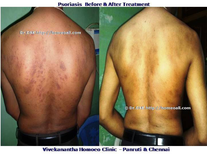  Psoriasis - சொரியாசிஸ் சொரியாசிஸ் - Psoriasis என்றால் என்ன ? சொரியாசிஸ் என்பது தோல் அழற்சி நிலையாகும். இதை மீன் செதில் படை என்றும் அழைக்கலாம். சொரியாசிஸ் தோலில் உள்ள செல்கள் வேகமாக இறப்பதன் மூலம் உண்டாகிறது. இதன் விளைவாக தோல் தடித்து மீன் செதில் போன்று இறந்த செல்கள் உதிரும், புரையோடும். தோலிலுள்ள பல சிறு இரத்த நாளங்கள் வீங்கிவிடுவதால் தோல் சிவப்பு நிறமாகக் காணப்படும். சொரியாசிஸ் எவ்வாறு தோற்றமளிக்கும்? • சொரியாசிஸ் என்பது தோலில், மீன் செதில் போன்று இறந்த செல்கள் உதிர்ந்து விழும் புரையுடன் கூடிய வெண்மை / சிவப்பு திட்டுகளாக (Silver Scaly patches) காணப்படும். • உடலின் எந்தப்பாகத்தில் வேண்டுமானாலும் வரலாம். • முழங்கை, முழுங்கால் மூட்டு, முதுகு, தலையுச்சி முதலிய பாகங்கள் பொதுவாக பாதிக்கப்படும். சொரியாசிஸ் தொற்று நோயா? • சொரியாசிஸ் தொற்று நோயல்ல. இது மற்றவர்களுக்கு பரவாது • சுகாதார குறைவு காரணமாக இது ஏற்படாது. சொரியாசிஸ் வர காரணம் என்ன ? • சொரியாசிஸ் மரபு காரணம் மற்றும் சுற்றுச் சூழல் நிலை இவற்றின் பாதிப்பினால் ஏற்படுகிறது என்று நம்பப்படுகிறது. • சொரியாசிஸால் பாதிக்கப்படுபவர்களில் 25% பேர் சொரியாசிஸ் நோயுடைய குடும்பத்திலிருந்து வந்தவர்களே, சிலருக்கு மரபு நிலை காரணமாகிறது. • உடல், மன அழுத்தங்கள், குரல்வளை தொற்று, ப்ளூ, ஸ்டீராய்ட் ஹார்மோன்ஸ், சில ஆண்ட்டி ஹைபர் டென்சிவ் போன்ற சில மருந்துகள், சோரியாசிஸை மேலும் மோசமாக்கும். • குடிபழக்கம், புகைபிடித்தல் சொரியாசிஸை மோசமாக்கும். சொரியாசிஸ் நோயின் விளைவுகள் • சொரியாசிஸ் நோயாளிகளுக்கு மூட்டுவலிகளும், வீக்கமும் வரலாம். • சொரியாசிஸ் விரல்களையும், கால்விரல் நகங்களையும் தாக்கி, சிறு குழிகளையும், கருமை நிறத்தையும், நகங்கள் தடிப்பையும், ஏற்படுத்தும். நகம் உடையலாம். சொரியாசிஸ் யாருக்கு வரும் ? • சொரியாசிஸ் ஆண், பெண் இருவரையும் சமமாகத் தாக்கலாம். • சொரியாசிஸ் எந்த வயதில் வேண்டுமானாலும் வரலாம். வழக்கமாக 20 வது வயதில் தாக்கத் தொடங்கும். பிறப்பிலிருந்தும் முதிய வயதிலும் கூட இது வரலாம். • ஒரு முறை சொரியாசிஸ் வந்ததும், குறைதல், தணிதல், அதிகரித்தல் என பல்வேறு நிலை மாற்றங்கள் ஏற்படும். சொரியாசிஸ்க்கு என்ன மருத்துவங்கள் உள்ளன. நவீன மருத்துவத்தில் பல மருந்துகள் உபயோகப்படுத்தப்படுகின்றன, டாபிகல் ஸ்டீராய்ட்ஸ் மேற்பூச்சுக்கள் (Steroids creams), போட்டோதெரபி, அல்ட்ரா வைலட், மெதாட்டுரக்ஸாட் (methotrexate) இத்தகைய மருந்துகள் பக்க விளைவுகளை ஏற்படுத்தும். எனவே நோயாளிகள் இந்தப் பக்க விளைவுகளைப் பரிசோதித்துக் கொள்ள அடிக்கடி இரத்த பரிசோதனை செய்து கொள்ள வேண்டும். மேலும் தொடர்ந்து இந்த மருந்துகளை உட்கொள்ளக்கூடாது. சொரியாசிஸ் நோயாளிகள் செய்யக்கூடாதவை, செய்ய வேண்டியவை  தோலைச் சொரியாதீர்கள் ஏனெனில் இது குணமாவதைத் தாமதப்படுத்தும்.  ஹோமியோபதி மருந்துகள் வேலை செய்து விளைவுகள் காட்ட பல வாரங்கள் ஆகுமாதலால் மருத்துவத்தை விரைவில், இடையில் நிறுத்திவிடாதீர்கள்.  சொரியாசிஸைக் கட்டுப்படுத்த தரப்பட்ட மருந்துகளையும், மருத்துவத்தையும் திடீரென்று நிறுத்திவிடாதீர்கள். இதனால் நோய் இன்னும் மோசமாகும்.  மருந்துகளை தொடர்ந்து சீராக எடுத்துக்கொள்ளுங்கள்.  தோலை எப்போதும் ஈரத்தன்மையுடையதாக வைத்திருங்கள். அது நமைச்சலையும், அரிப்பையும், புரை ஏற்படுவதையும் தடுக்கும்.  சூரிய ஒளியில் இருப்பது பொதுவாக நல்லதே, ஆனால் அதிகமாக வெகு நேரம் இருப்பதால் வேர்க்குருக்கள் உண்டாகும். அதனால் சொரியாசிஸ் தீவிரமடையும்.  மன அழுத்தம் சொரியாசிஸை அதிகப்படுத்தும். அமைதியாக இருக்கவும், உடற்பயிற்சி செய்யவும், ஒய்வு எடுத்துக்கொள்ளவும், சோரியாஸிஸ் ஹோமியோபதி மருத்துவ சிகிச்சை, நோயின் அறிகுறிகளுக்கேற்ற ஹோமியோபதி மருத்துவசிகிச்சை நோயின் தன்மையை நன்கு கட்டுப்படுத்தி விரைவில் நல்ல பலனளிக்கும். தொடர்ந்து ஹோமியோபதி மருந்துகளை உட்கொள்வதன் மூலம் நல்ல பலன்பெறலாம். ஹோமியோபதி சிகிச்சைக்கு தொடர்பு கொள்ளவும் ஹோமியோபதி சிறப்பு மருத்துவர் செந்தில் குமார் தண்டபாணி அவர்களிடம் இதைப்போன்ற நோய்களுக்கு சிகிச்சை பெற்று பலர் நல்ல பலனடைந்திருக்கிறார்கள். மருத்துவர் செந்தில் குமார் அவர்களை சென்னை, வேளச்சேரி விவேகானந்தா ஹோமியோபதி கிளினிக் & உளவியல் ஆலோசனை மையத்தில் சந்திக்கலாம். முன்பதிவு அவசியம். முன்பதிவிற்கு தொடர்புகொள்ளவும் 9786901830, மின் அஞ்சல்: consult.ur.dr@gmail.com மேலும் விபரங்களுக்கும் ஆலோசனைக்கும் சிகிச்சைக்கும் தொடர்பு கொள்க விவேகானந்தா கிளினிக் ஆலோசனை மையங்கள் & தொடர்பு எண்கள் சென்னை:- 9786901830 பண்ருட்டி:- 9443054168 புதுச்சேரி:- 9865212055 (Camp) மின் அஞ்சல் : consult.ur.dr@gmail.com, homoeokumar@gmail.com முன்பதிவிற்கு அழைக்கவும் அல்லது மின் அஞ்சல் அனுப்பவும். முன்பதிவிற்கு: உங்களின் பெயர் - வயது – அலைபேசி எண் – பிரச்சனை (ஒரு வரியில்) தேதி – கிழமை – இடம், முதலியவற்றை குறுந்தகவல் மூலம் அனுப்பவும். உதாரணம்: ரம்யா - 28 – 99******00 – சோரியாசிஸ் Psoriasis – 20-12-2014 – சனிக்கிழமை – சென்னை, மருத்துவர் உங்களின் முன்பதிவை குறுந்தகவல் மூலம் உறுதிப்படுத்துவார்.