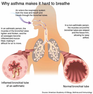 asthma ஆஸ்துமா ஆஸ்துமா என்றால் என்ன ? • ஆஸ்துமா என்பது சுவாசக்குழாய்களை பாதிக்கும் ஒரு நாள்பட்ட நோய். • ஈழை நோய் அல்லது ஈளை அல்லது மூச்சுத்தடை நோய் (Asthma, ஆஸ்துமா) என்பது நுரையீரலில் ஏற்படும் நீடித்த/நாட்பட்ட (Chronic) அழற்சியினால் மீண்டும் மீண்டும் வரக்கூடிய (Recurrent) மூச்சு எடுத்தலில்/விடுதலில் சிரமத்தைக் கொடுக்கும் • மூச்சுத்திணறல்/மூச்சிரைப்பு நிலை ஆகும். இதற்கு முக்கியக் காரணம் சுவாசக் குழாய்களின் உட்படலத்தில் ஏற்படும் வீக்கத்தால் காற்று உட்சென்று வெளியேறும் பாதை குறுகி காற்றின் ஓட்டத்தில் ஏற்படும் தடையாகும். இந்த ஈழை நோயானது தொய்வு, இழுப்பு, முட்டு, சுவாச முட்டு, இழைப்பு நோய், மூச்சுத் தடை நோய், மூச்சுப் பிடிப்பு நோய் என பல்வேறு பெயர்கள் கொண்டு அழைக்கப்படுகிறது ஆஸ்துமா எப்படி ஏற்படுகிறது? ஆஸ்துமா உள்ள நபர்களுக்கு, சுவாசக்குழாய்களின் உட்சுவர் வீங்கியிருக்கும். இந்த வீக்கமானது சுவாசக்குழாயில் அலர்ஜி எனப்படும் ஓவ்வாமையை ஏற்படுத்தக்கூடிய பொருட்களோ அல்லது மூச்சுக் குழாய்களில் எரிச்சலை ஏற்படுத்தக்கூடிய பொருட்களோ (உம். புகை, தூசி) செல்லும்போது சுவாசக்குழாய்கள் இப்படிப்பட்ட பொருட்களுக்கு எதிராக செயல்படும். இப்படி சுவாசக்குாழய்கள் எதிரிடையாக செயல்படும் போது சுவாசக் குழாய்களின் உள் சுற்றளவு குறைந்து, சாதாரண அளவைவிட மிக குறைந்தளவு காற்றே நுரையீரலின் காற்றுப் பரிமாணம் நடக்கும் இடத்திற்கு செல்கிறது. இதனால், மிகுந்த சிரமத்துடன் மூச்சு விடும் நிலைமை விசில் சத்தத்துடன், இருமல், மார்பு பகுதி இறுக்கமடைதல் மற்றும் சுவாசக்கோளாறு போன்றவற்றை உண்டாக்குகிறது. இவை அனைத்தும் குறிப்பாக இரவு மற்றும் அதிகாலை நேரங்களில் காணப்படும். ஆஸ்துமாவை குணப்படுத்த முடியுமா? ஆஸ்துமா நோயை பூரணமாக குணப்படுத்த முடியாது. ஆனால் ஆஸ்துமா நோய்கண்ட நிறைய பேர் சரியான முறையான சிகிச்சை எடுத்துக்கொள்வதால் இந்த நோய் கட்டுப்பாட்டில் இருக்கும். ஒருசில நேரங்களில் நோயின் தாக்கம் இருப்பினும், அவர்களும் மற்றவர்களை போல சுறுசுறுப்பான வாழ்க்கை வாழ்கின்றனர். எனவே ஒருவர் ஆஸ்துமா வியாதியினால் பாதிக்கப்பட்டால், அவர் மருத்துவரை சந்தித்து, முறைப்படி மருத்துவ உதவியை பெற்றுக்கொள்ள வேண்டும். எதனால் ஆஸ்துமா வருகிறது, அதனை எப்படி தவிர்க்கலாம் என்பதனையும், அறிந்து கொள்ள வேண்டும். ஆஸ்துமா வருவதற்கான சில பொதுவான காரணங்களில் அலர்ஜென்ஸ் எனப்படும் ஒவ்வாமை பொருட்கள் எரிச்சலூட்டும் பொருட்கள் மற்றும் வைரஸ் நோய் தொற்று போன்றவையும் அடங்கும். சிலருக்கு உடற்பயிற்சி செய்யும் போதும் அல்லது வைரஸ் கிருமிகளால் தாக்கப்படும் போதும் மட்டும், ஆஸ்துமா வியாதி காணப்படுகிறது. பொதுவான அலர்ஜென்ஸ் - Allergens - ஒவ்வா பொருட்கள்,  மிருகங்களின் உடலின் மேல் உள்ள தோலில், முடியில் மற்றும் இறகுகளிலிருந்து வரும் கழிவுகள் – Animal dander  தூசி மற்றும் தூசியில் உள்ள சிறு பூச்சி (வீடுகளில் தூசியில் காணப்படுபவை – House mite )  கரப்பான்பூச்சி – Cockroach  மரங்கள் மற்றும் புல்களிலிந்து வரும் மகரந்தத்தூள் – Pollens  உள்ளும் வெளியிலும் பயன்படுத்தப்படும் மேல் பூசு பொருட்கள் - பெயின்ட், டிஸ்டம்பர் போன்றவை – Paint, Petroleum products  சிகரட் புகை – Cigarette Smoke  காற்றில் காணப்படும் மாசுப்பொருட்கள் – Polluted Air  குளிர்ந்த காற்று அல்லது சீதோஷணநிலை மாற்றம் – Chill or Climate changes  வண்ணப்பூச்சுப் பொருள் மற்றும் சமைக்கும் பொழுது வரும் வாசனை –and Colored foods, and Food Smells while Cooking  நறுமண மூட்டப்பட்ட பொருட்கள் Perfumes & Sprays  கடுமையான மன உணர்வுகளை வெளிப்படுத்துதல், அழுதல் அல்லது சிரித்தல், Over excitement, Laughing, Weeping, Depression, and Stress,  ஆஸ்பரின் மற்றும் பீட்டா பிளாக்கர்ஸ் எனப்படும் மருந்துகள் – Aspirins and Beta Blockers  உணவில் உலர்ந்த பழவகைகளில் சல்பைட்ஸ் போன்ற பொருட்கள் அல்லது மதுபான வகைகள், திராட்சை மது Sulfides, Alcohol,  வயிறு மற்றும் உணவுக்குழாய் பாதிப்பினால் நெஞ்சு எரிச்சல் ஏற்படுவது ஆஸ்த்துமாவின் அறிகுறிகளை, பாதிப்புகளை அதிகப்படுத்தி, மோசமான நிலைமைக்கு கொண்டு செல்லும்.- Gastritis, GERD ( Gastero Esophageal Reflexive Diseases),  அலர்ஜின்ஸ் எனப்படும் ஒவ்வாப்பொருள் மற்றும் எரிச்சலூட்டும் பொருட்கள் எவையெனில் இராசாயனப் பொருட்கள் மற்றும் தூசிப் பொருட்கள். Allergens, Chemicals, Dusts,  நோய்தொற்றுதல் – Bacterial or Viral Infection,  குடும்ப பின்னணி Hereditary,  குழந்தைகள் புகையிலையிலிருந்து வருகின்ற புகையினை சுவாசிக்க நேரிடும் போது, ஆஸ்துமா வருகிறது. ஒரு கர்ப்பிணிப் பெண், புகையிலையிலிருந்து வரும் புகையினை சுவாசிக்க நேரிடும் போது வயிற்றில் வளரும் குழந்தைக்கு எளிதில் ஆஸ்துமா வருகிறது. Passive smoking children, and Pregnant women,  உடற்பருமனாகுதல், பிற சுகாதாரக் கேடுகள் ஆஸ்துமா மற்றும் வியாதியோடு தொடர்புடையவைகளாக இருக்கலாம். Obesity and other Health related issues, ஆஸ்துமா நோயின் அடையாள அறிகுறிகள் Signs and Symptoms  மூச்சுத்திணறல் - திடீரென பாதிப்புக்குள்ளாகுதல், அடிக்கடி மூச்சுத்திணறல் ஏற்படுதல் – Difficulty in Breathing, Suffocation  இரவு மற்றும் அதிகாலை வேளைகளில் பாதிப்பு மோசமாகுதல் – Aggravation at Early morning and night,  குளிர்ச்சியான பகுதிக்கு செல்லும்போது அல்லது உடற்பயிற்சி செய்யும் போது Exercise and High attitude நிலைமை மோசமாகுதல் மற்றும் நெஞ்செரிச்சல் காணப்படும். பின்னர் தானகவே மறைந்துவிடும்  இருமல் அல்லது சளியுடன் கூடிய இருமல் Cough with Sputum  மூச்சு இறைப்பினால் நிலைமை மோசமாகுதல் குறிப்பாக உடற்பயிற்சி மேற்கொள்ளும் போது அல்லது மற்றபிற சாதாரண வேலைகளை செய்யும் போது. Physical excitement மருத்துவம் நவீன மருந்துகளில் ஸ்டீராய்ட் எனப்படும் ஊக்கி மருந்துகளை உபயோகித்து ஆஸ்த்துமா கட்டுப்படுத்தப்படுகிறது. ஆனால் இதனால் நிறைய பக்க விளைவுகளை நோயாளிகள் எதிர்கொள்கிறார்கள் ஆஸ்த்துமா ஹோமியோபதி மருத்துவம் ஆஸ்த்துமா நோய்க்கு நோயின் அறிகுறிகளுக்கேற்ற ஹோமியோபதி மருந்துகளை உட்கொள்ளும்போது நன்கு கட்டுப்படுப்படும். மேலும் நோய் எதிர்ப்புத்தண்மையும் அதிகரிப்பதால் நோயின் தாக்கம் நன்கு குறைந்து அடிக்கடி வரும் தன்மையும் குறையும். பொதுவாக ஆஸ்த்துமாவிற்க்கு ஹோமியோபதி மருத்துவம் நல்ல பலனளிக்கும். ஹோமியோபதி சிகிச்சைக்கு தொடர்பு கொள்ளவும் ஹோமியோபதி சிறப்பு மருத்துவர் செந்தில் குமார் தண்டபாணி அவர்களிடம் இதைப்போன்ற ஆஸ்துமா நோய்க்கு சிகிச்சை பெற்று பலர் நல்ல பலனடைந்திருக்கிறார்கள். மருத்துவர் செந்தில் குமார் அவர்களை சென்னை, வேளச்சேரி விவேகானந்தா ஹோமியோபதி கிளினிக் & உளவியல் ஆலோசனை மையத்தில் சந்திக்கலாம். முன்பதிவு அவசியம். முன்பதிவிற்கு தொடர்புகொள்ளவும் 9786901830, மின் அஞ்சல்: consult.ur.dr@gmail.com மேலும் விபரங்களுக்கும் ஆலோசனைக்கும் சிகிச்சைக்கும் தொடர்பு கொள்க விவேகானந்தா கிளினிக் ஆலோசனை மையங்கள் & தொடர்பு எண்கள் சென்னை:- 9786901830 பண்ருட்டி:- 9443054168 புதுச்சேரி:- 9865212055 (Camp) மின் அஞ்சல் : consult.ur.dr@gmail.com, homoeokumar@gmail.com முன்பதிவிற்கு அழைக்கவும் அல்லது மின் அஞ்சல் அனுப்பவும். முன்பதிவிற்கு: உங்களின் பெயர் - வயது – அலைபேசி எண் – பிரச்சனை (ஒரு வரியில்) தேதி – கிழமை – இடம், முதலியவற்றை குறுந்தகவல் மூலம் அனுப்பவும். உதாரணம்: ரம்யா - 28 – 99******00 – ஆஸ்த்துமா Asthma – 20-12-2014 – சனிக்கிழமை – சென்னை, மருத்துவர் உங்களின் முன்பதிவை குறுந்தகவல் மூலம் உறுதிப்படுத்துவார்.