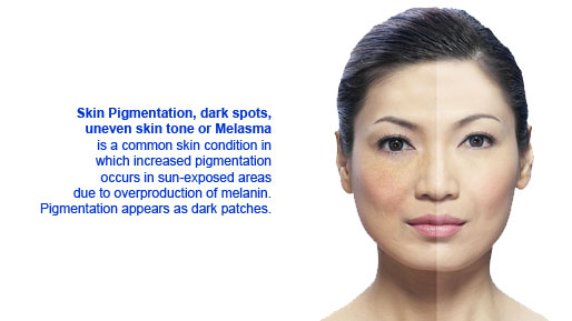 pigmentation treatment specialsit dr.senthil kumar vivekananda homeo clinic velachery chennai, tamilnadu india hospital PIGMENTATION What is the basic structure of the skin and what is responsible for giving it a color ? Skin is the largest organ of the body. It is made up of two layers, the upper 'epidermis' and the lower 'dermis'. The epidermis and the dermis are further divided into other layers. The lower most layer of the epidermis is known as the basal layer and it contains organelles called 'melanosomes'. These melanosomes contain cells called melanocytes which produce a pigment called 'melanin'. The color of skin depends mainly on this melanin and the amount of melanin present in the other layers of the epidermis. The thickness of epidermis and vascularity of the epidermis are other factors affecting the color of skin. What are the causes of hypo pigmentation (decrease in skin pigmentation) ? 1. Pityriasis alba : Hypo pigmented patch may be seen on the face usually in young children. It is common in winter and in those with history of atopy. It can be treated with a mild topical steroid. 2. Pityriasis versicolor : It is a superficial fungal infection caused by a yeast 'pityrosporum orbiculare'. Well defined hypo or hyper pigmented lesions with fine scales are found on the chest, back, neck and sometimes on the face. It is treated with topical and oral anti fungal drugs. 3. Leprosy : It is a chronic disease caused by 'mycobacterium leprae' and affects mainly the skin and nerves. A hypo pigmented patch with absent or decreased sensation is seen in tuberculoid type of leprosy (good immune response) whereas in lepromatous type (low immune response) the sensations may be normal. It can be cured with the help of drugs. 4. Vitiligo : This is an autoimmune diseases where de pigmented patches are seen, they may occur any where on the body.. 5. secondary leucoderma : This occurs due to contact with certain chemicals phenol derivatives, glue of 'bindi', rubber slippers, plastic watch straps, photograph developing solutions or burns. It can be treated by spot dermabrasion or skin grafting. 6. Post inflammatory hypo pigmentation : It occurs after the healing phase of certain dermatoses such as eczemas, psoriasis, candidiasis etc. 7. Nevus depigmentosus : It is a congenital, well defined, hypo pigmented patch present since birth. It can be treated by spot dermabrasion or ablation with Co2 laser followed by ultra thin skin grafting. What are the causes of hyper pigmentation (increase in skin pigmentation) ? Hyper pigmentation may either be due to increased melanin deposition in the epidermis or dermis. Epidermal pigmentary disorders respond well to treatment while dermal pigmentation may take a long time to lighten. 1. Melasma : Seen as brown patches on the face, it is more commonly seen in females. It occurs due to hormonal changes in the body. The pigmentation increases on sun sun exposure. 2. Peri-orbital melanosis : Also known as 'dark circles' may be heriditary, due to stress or eye strain 3. Freckles and Lentigenes : These are tiny black spots on the face and are genetic in origin. 4. Photomelanosis : This is increased pigmentation due to sun exposure. The pigmentation occurs on exposed skin, commonly on the face, neck and the back. The pigmentation may be patchy or as diffused darkening of the exposed skin. Sun burn (tan) : A condition commonly encountered in fair skinned people due to excessive sun exposure. 5. Post inflammatory hyper pigmentation : It may be seen in the following cases • Seen after healing has occured, like in acne, eczemas, contact dermatitis etc. • Drug induced pigmentation. • Pigmentation due to cosmetics especially those containing fragrance. 6. Macular lichen amyloidosis. 7. Nevus or 'Birth mark' : Usually seen at birth but may also appear at a later age. 8. Tattoo : Tattoos are pigments inserted into the skin for decorative purpose which may at times be a part of tradition. Usually these artificial pigments are inserted deep into the dermis which makes them permanent and stubborn. What is the treatment for hyper pigmented disorders ? Melasma, Photomelanosis and post inflammatory hyper pigmentation can be treated with topical creams such as hydroxy quinone, tretinoin, topical steroids ,alpha hydroxy acid creams or azelic acid. If the patient does not improve with these medicines other modalities should be used, which may be ; For more details & Consultation Feel free to contact us. Vivekanantha Clinic Consultation Champers at Chennai:- 9786901830 Panruti:- 9443054168 Pondicherry:- 9865212055 (Camp) Mail : consult.ur.dr@gmail.com, homoeokumar@gmail.com For appointment please Call us or Mail Us For appointment: SMS your Name -Age – Mobile Number - Problem in Single word - date and day - Place of appointment (Eg: Rajini - 99xxxxxxx0 – Pigmentation Disorders – 21st Oct, Sunday - Chennai ), You will receive Appointment details through SMS