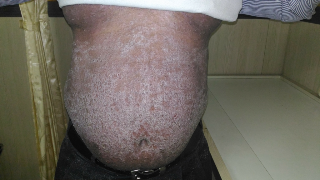  Psoriasis best homeopathy doctor treatment in Chennai