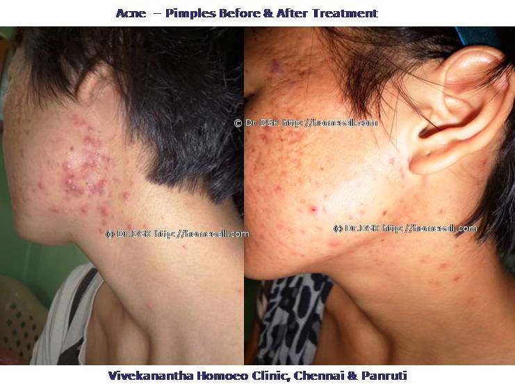 Acne-Pimples Homeopathy Treatment - मुँहासे-मुर्गी होम्योपैथी उपचार