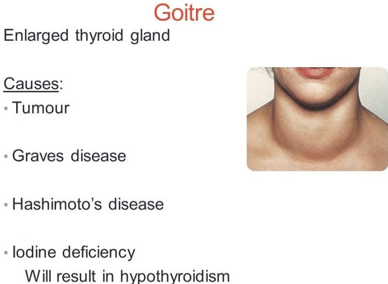 Homeoall» Blog Archive » Hashimoto’s disease. Iodine deficiency. Will