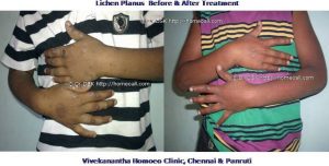 lichen-planus-homeopathy-treatment