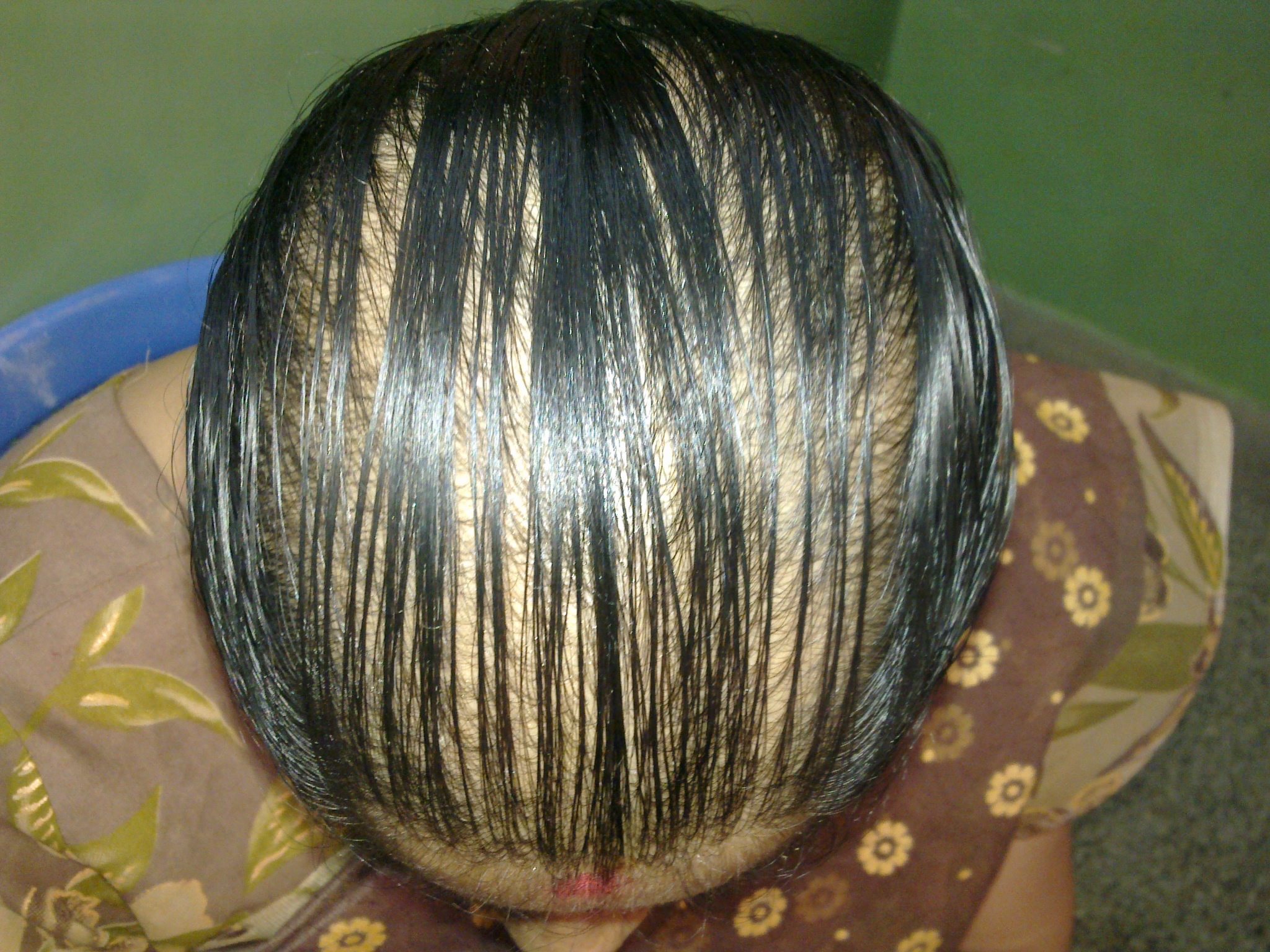 female pattern baldness treatment 