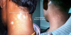 லூகோடெர்மா குணமாகுமா