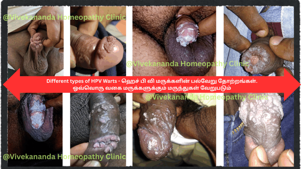 HPV வராமல் தடுப்பது எப்படி